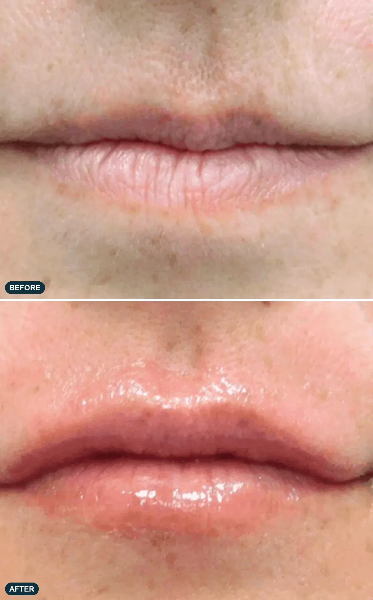 Lips, front view, before and after clinical case supplied by the manufacturer