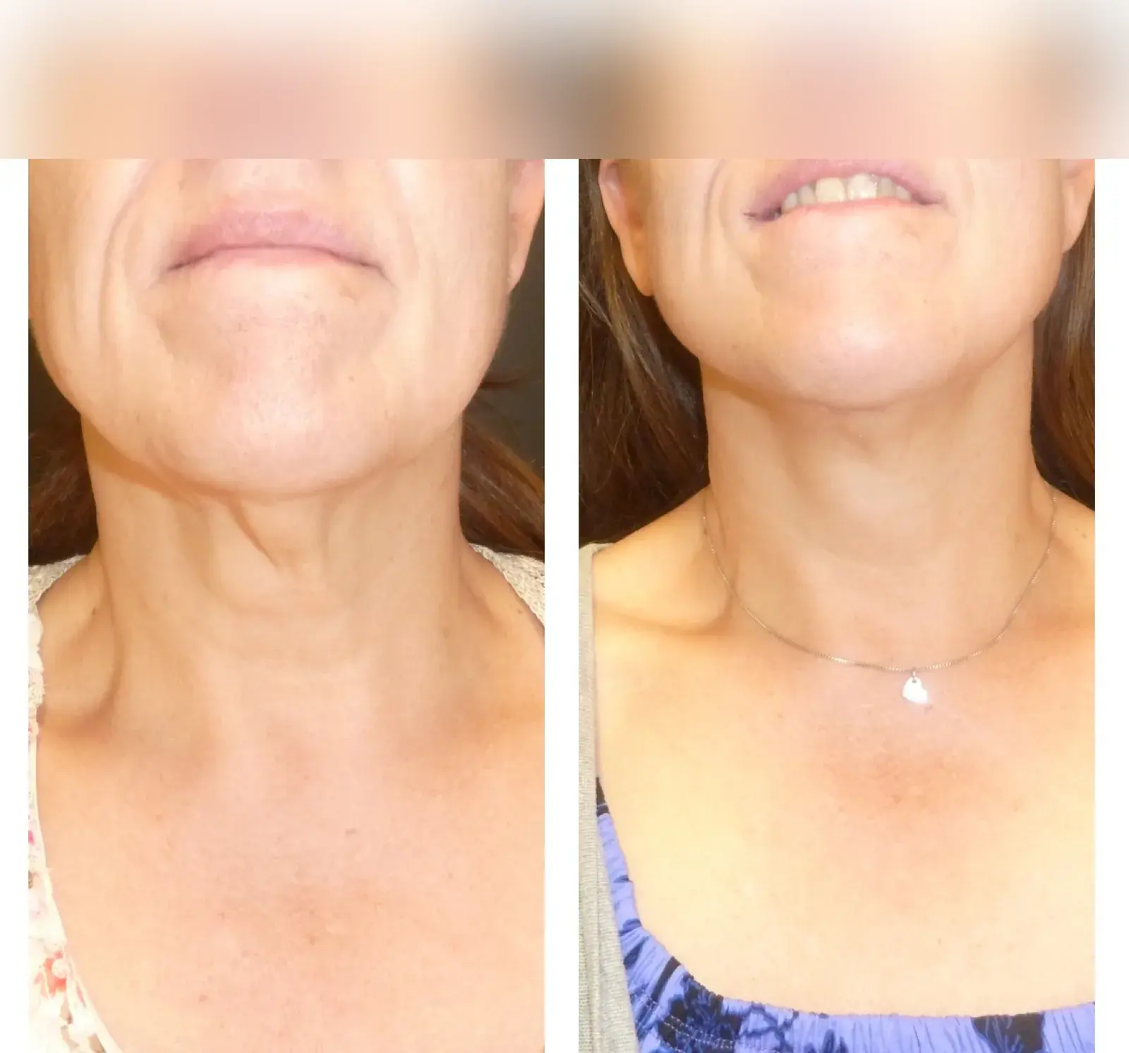 Neck, front view, before and after at Barrie Plastic Surgery