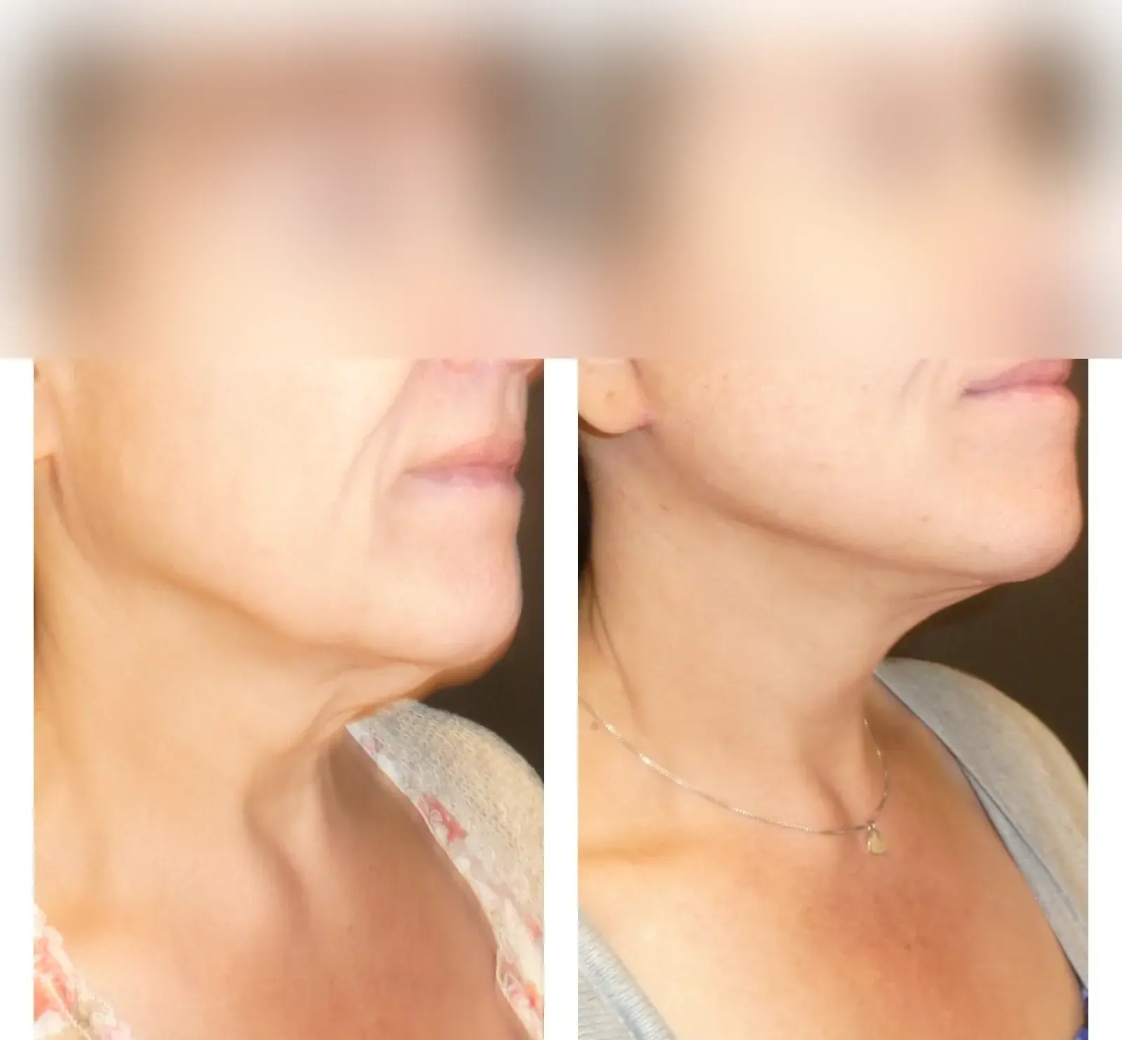 Neck, oblique view, before and after at Barrie Plastic Surgery