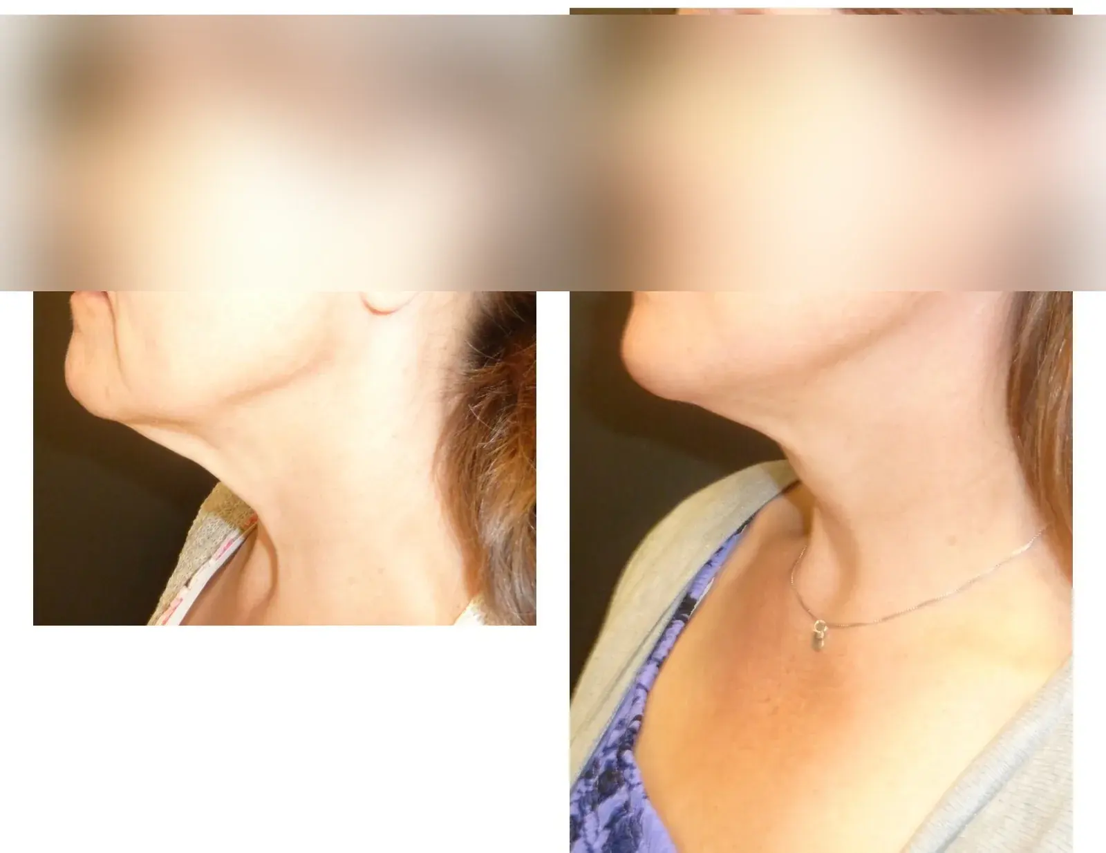 Neck, side view, before and after at Barrie Plastic Surgery