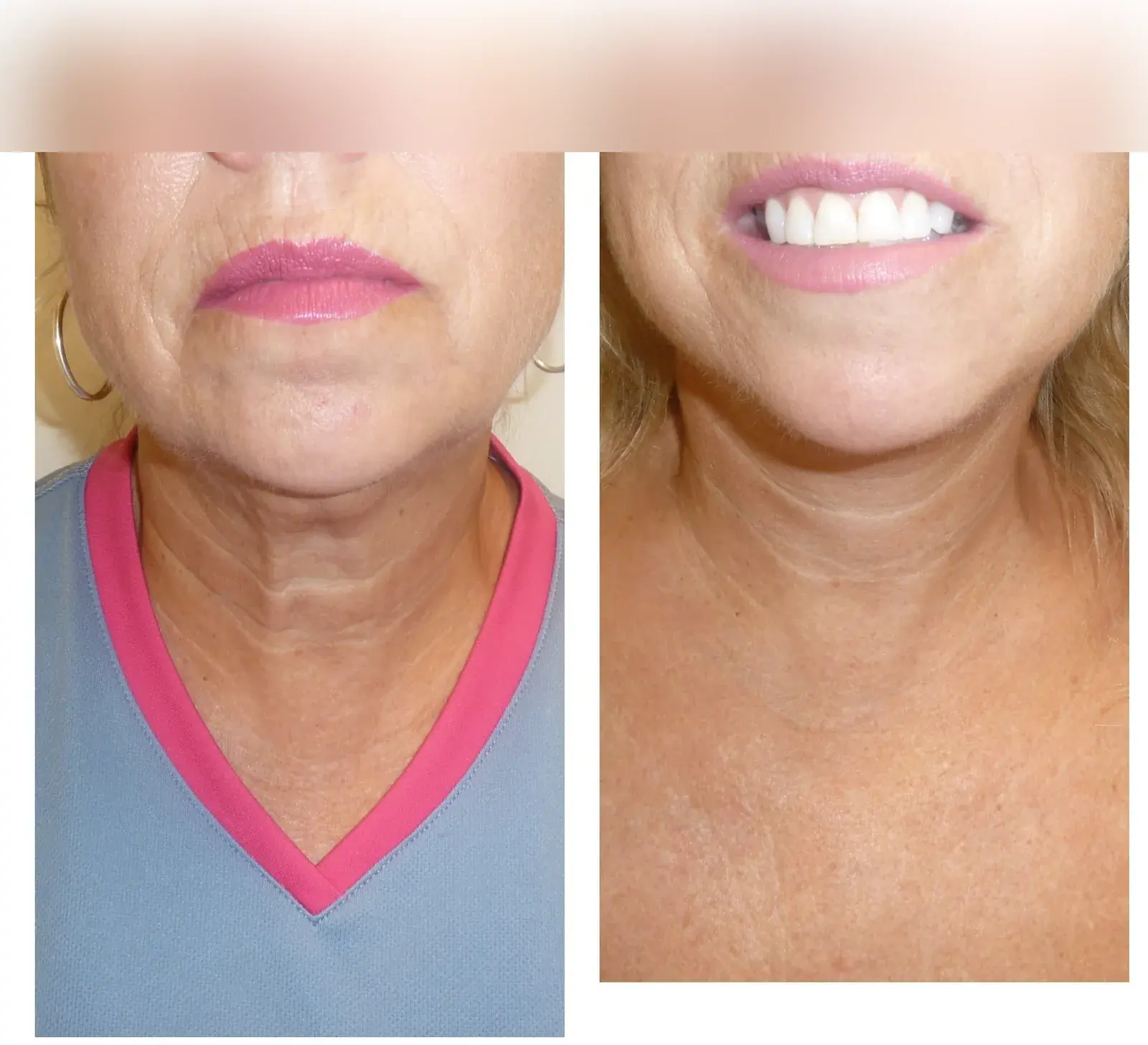 Neck, front view, before and after at Barrie Plastic Surgery