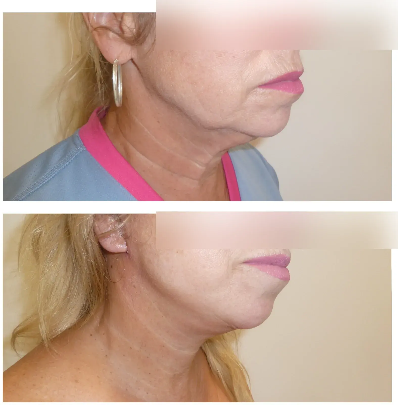 Neck, side view, before and after at Barrie Plastic Surgery