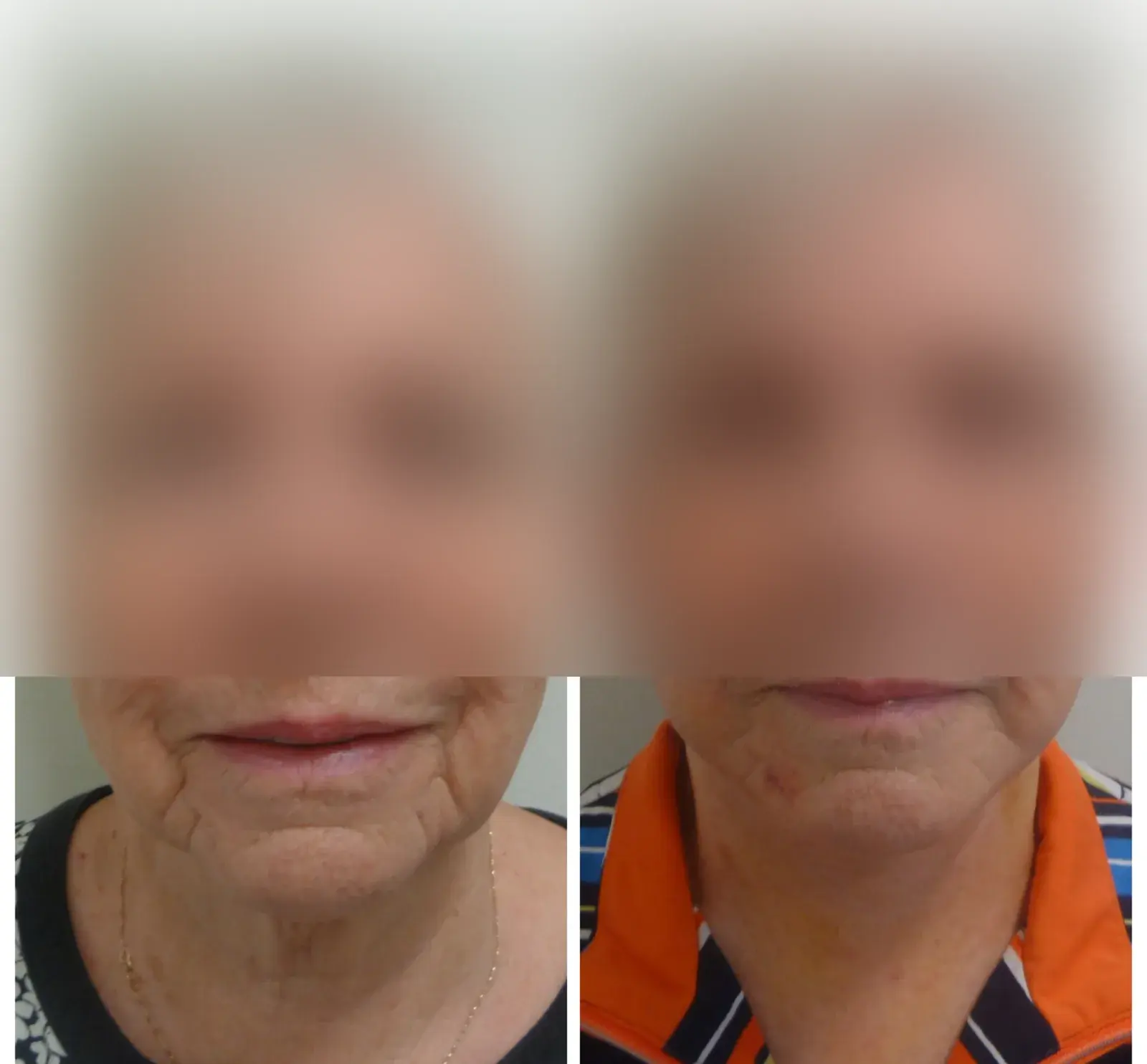 Face and neck, front view, before and after at Barrie Plastic Surgery