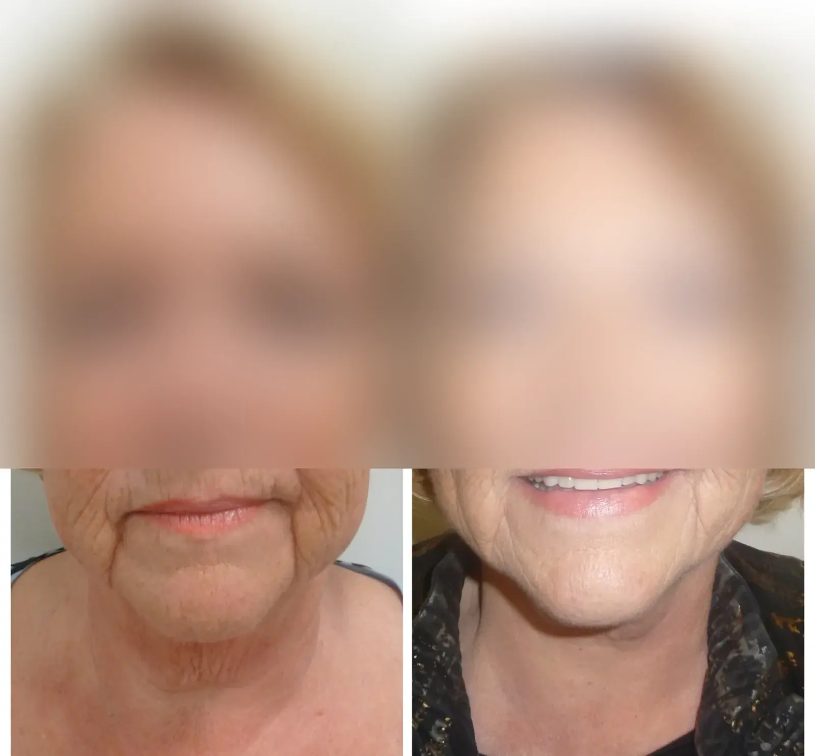 Face and neck, front view, before and after at Barrie Plastic Surgery