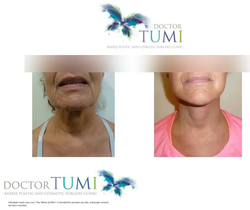 Neck, front view, before and after at Barrie Plastic Surgery