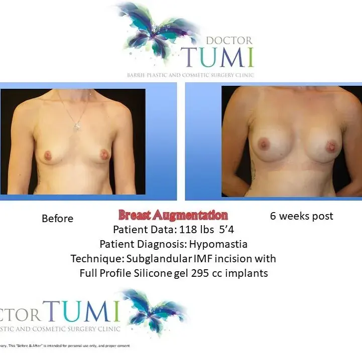 Breast, front view, before and after at Barrie Plastic Surgery