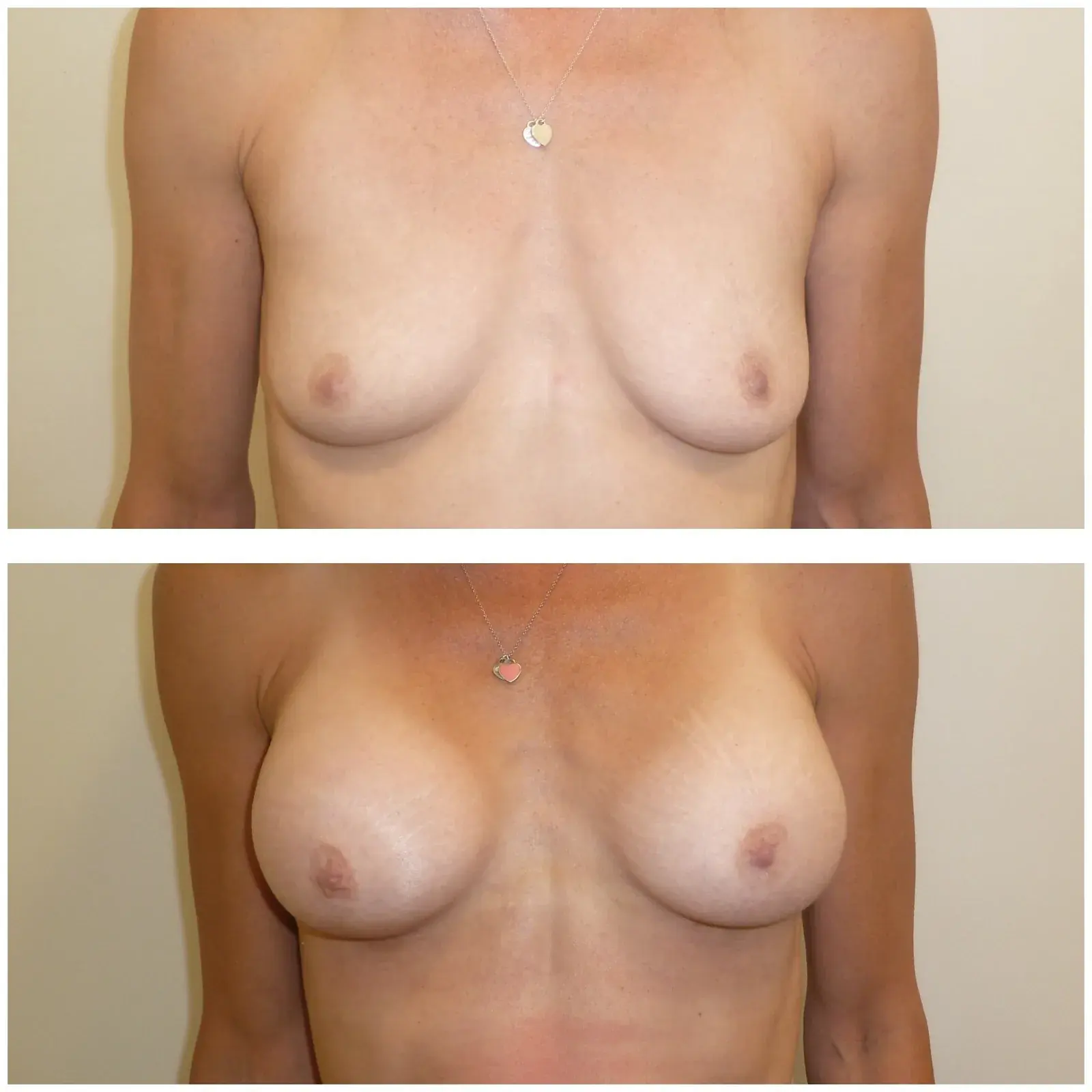 Breast, front view, before and after at Barrie Plastic Surgery