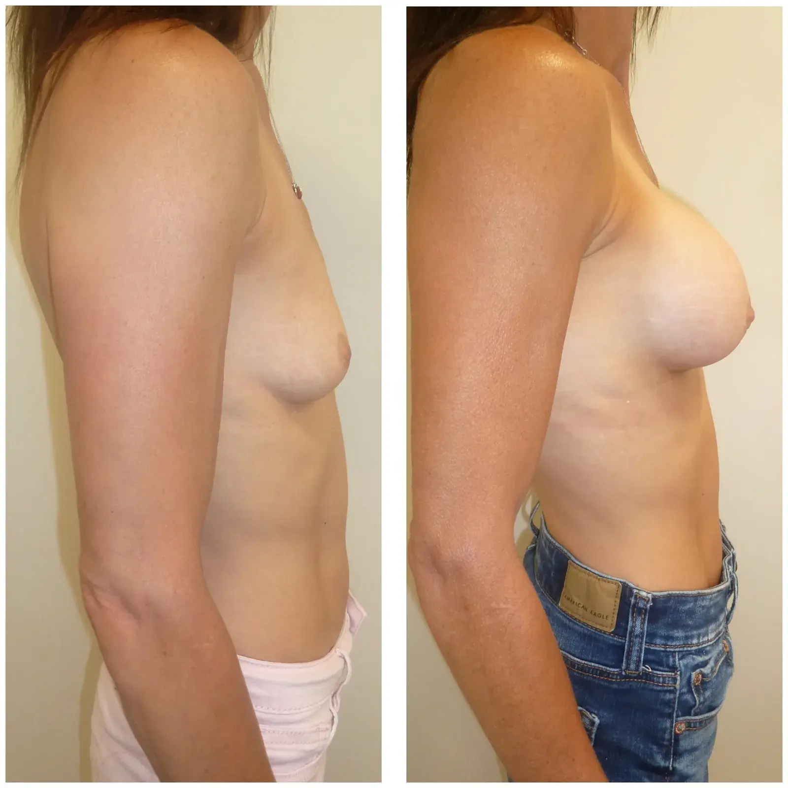 Breast, side view, before and after at Barrie Plastic Surgery