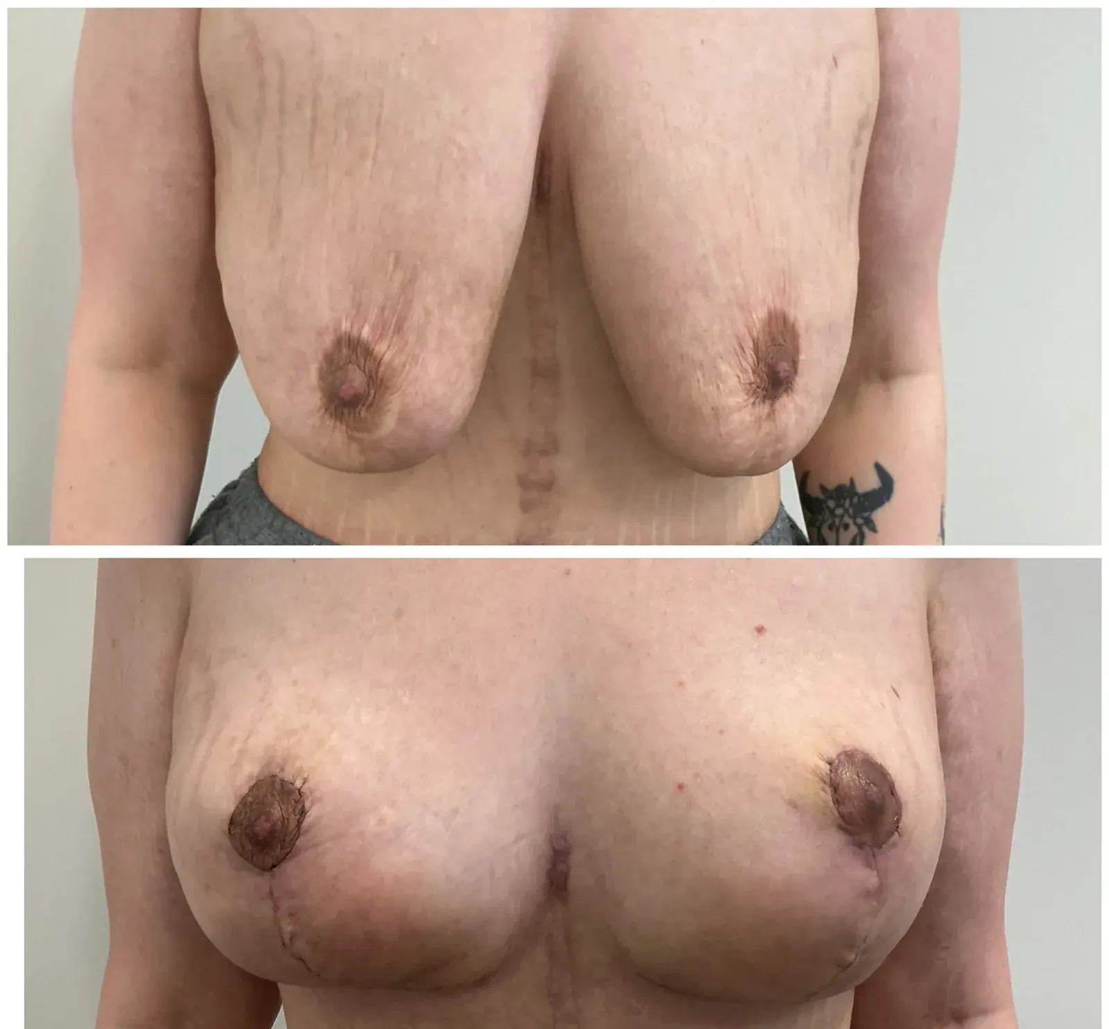 Breast, front view, before and after at Barrie Plastic Surgery