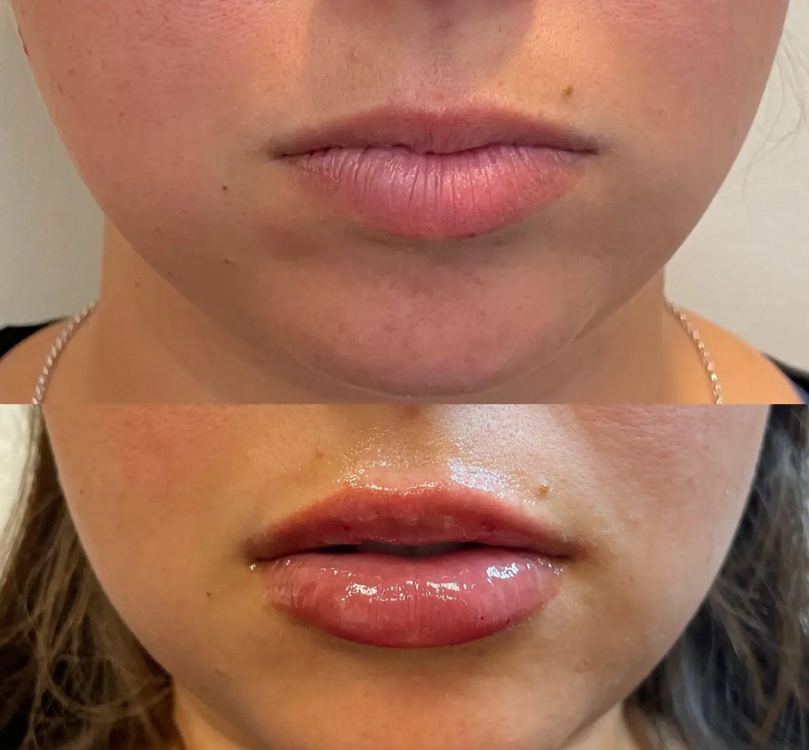 Lips, front view, before and after at Barrie Plastic Surgery