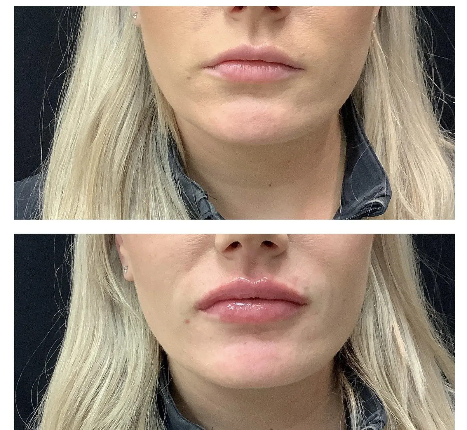 Lips, front view, before and after at Barrie Plastic Surgery