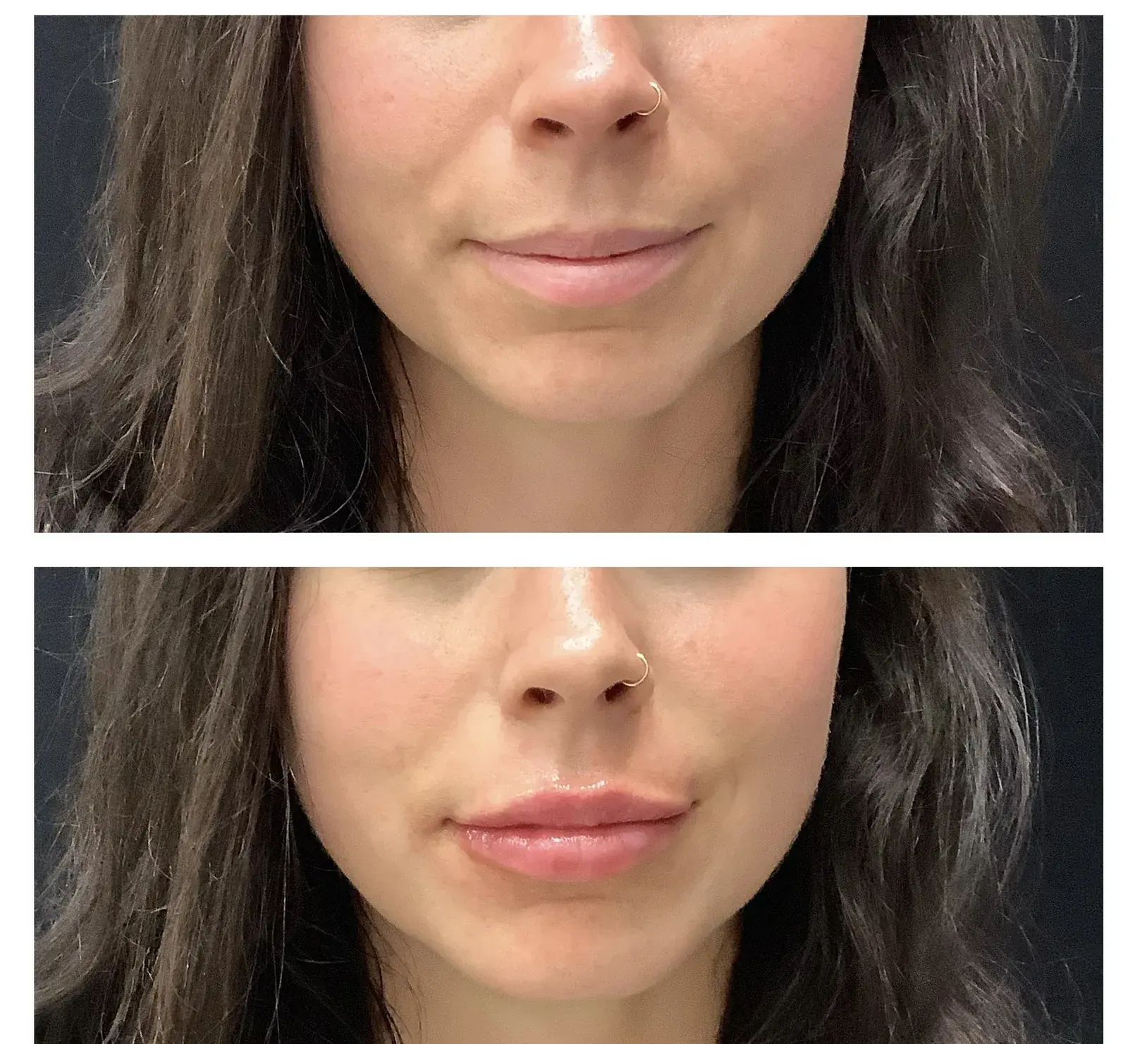Lips, front view, before and after at Barrie Plastic Surgery