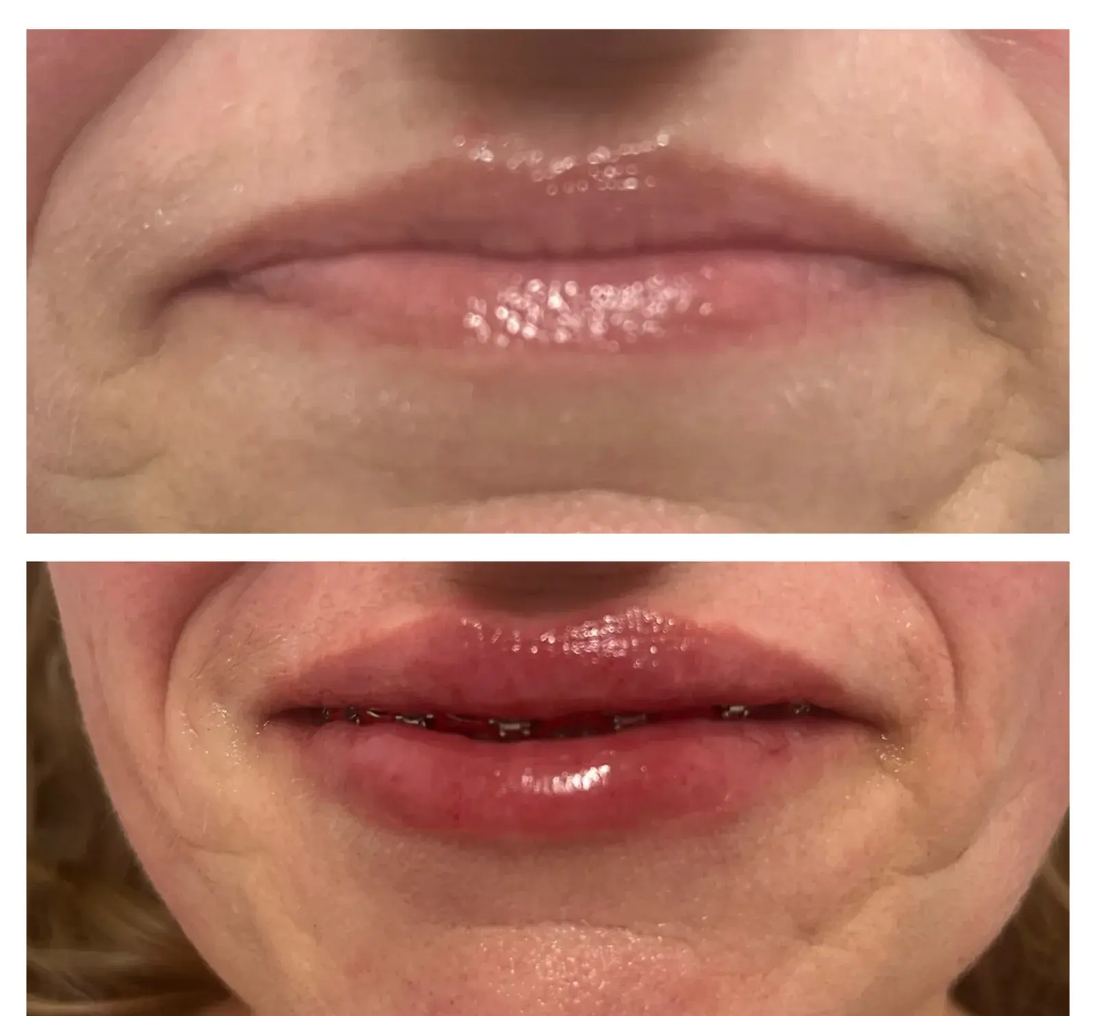 Lips, front view, before and after at Barrie Plastic Surgery
