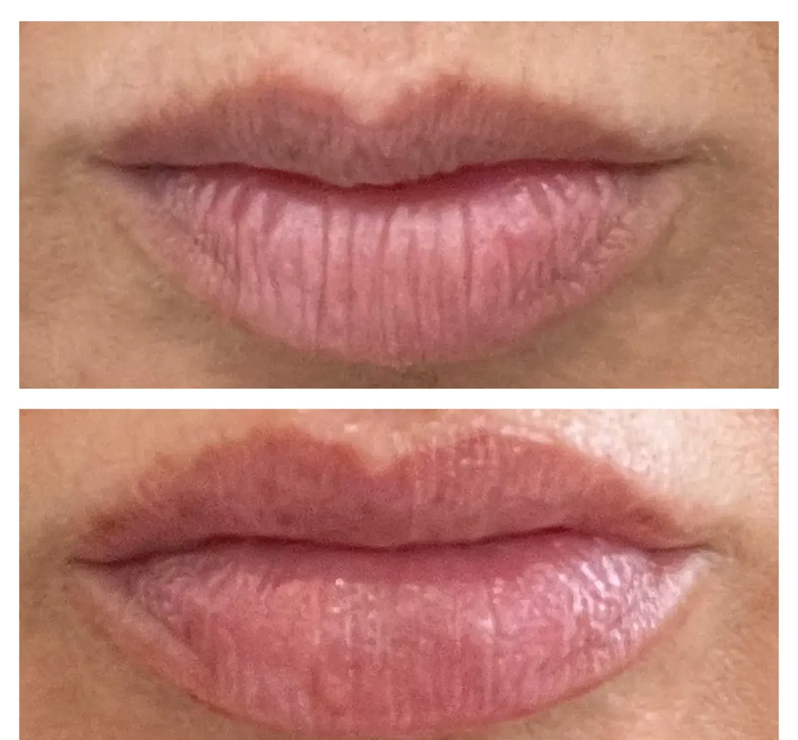 Lips, front view, before and after at Barrie Plastic Surgery