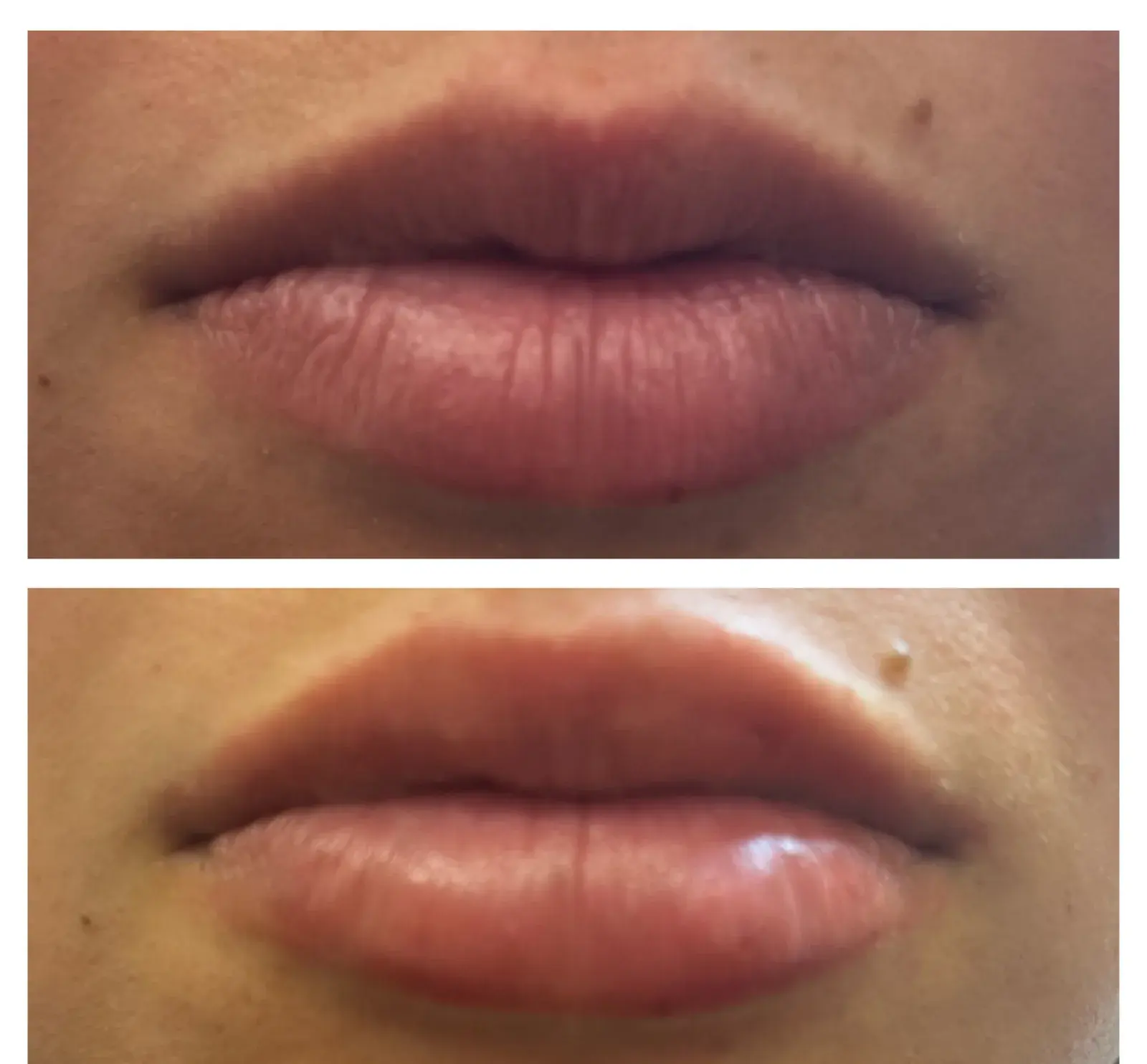 Lips, front view, before and after at Barrie Plastic Surgery