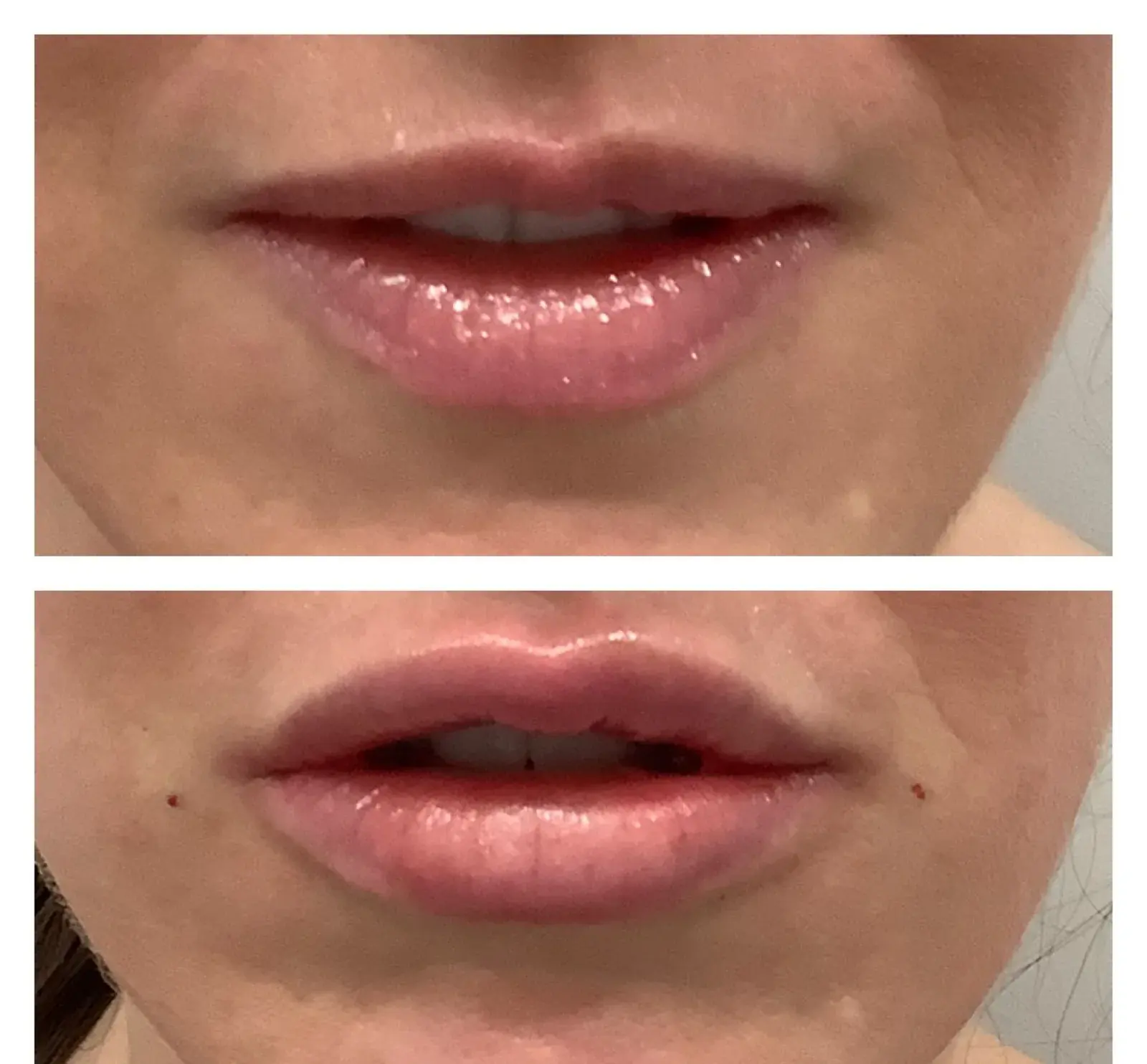Lips, front view, before and after at Barrie Plastic Surgery