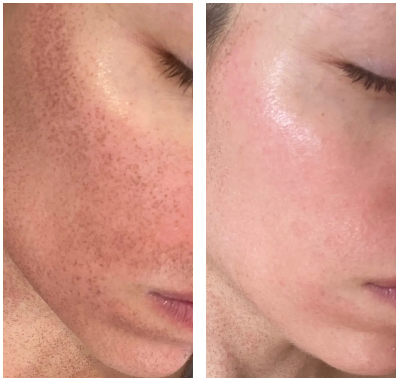 Cheek, close-up view, before and after at Barrie Plastic Surgery