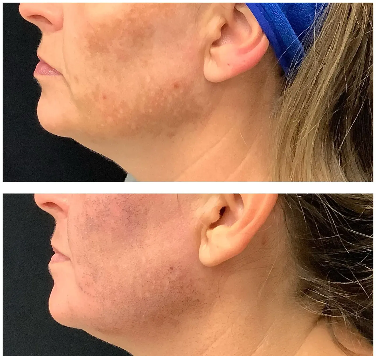 Before and after result, patient of Barrie Plastic Surgery