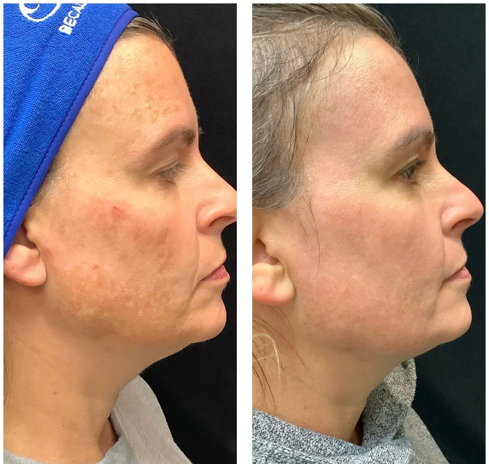 Before and after result, patient of Barrie Plastic Surgery