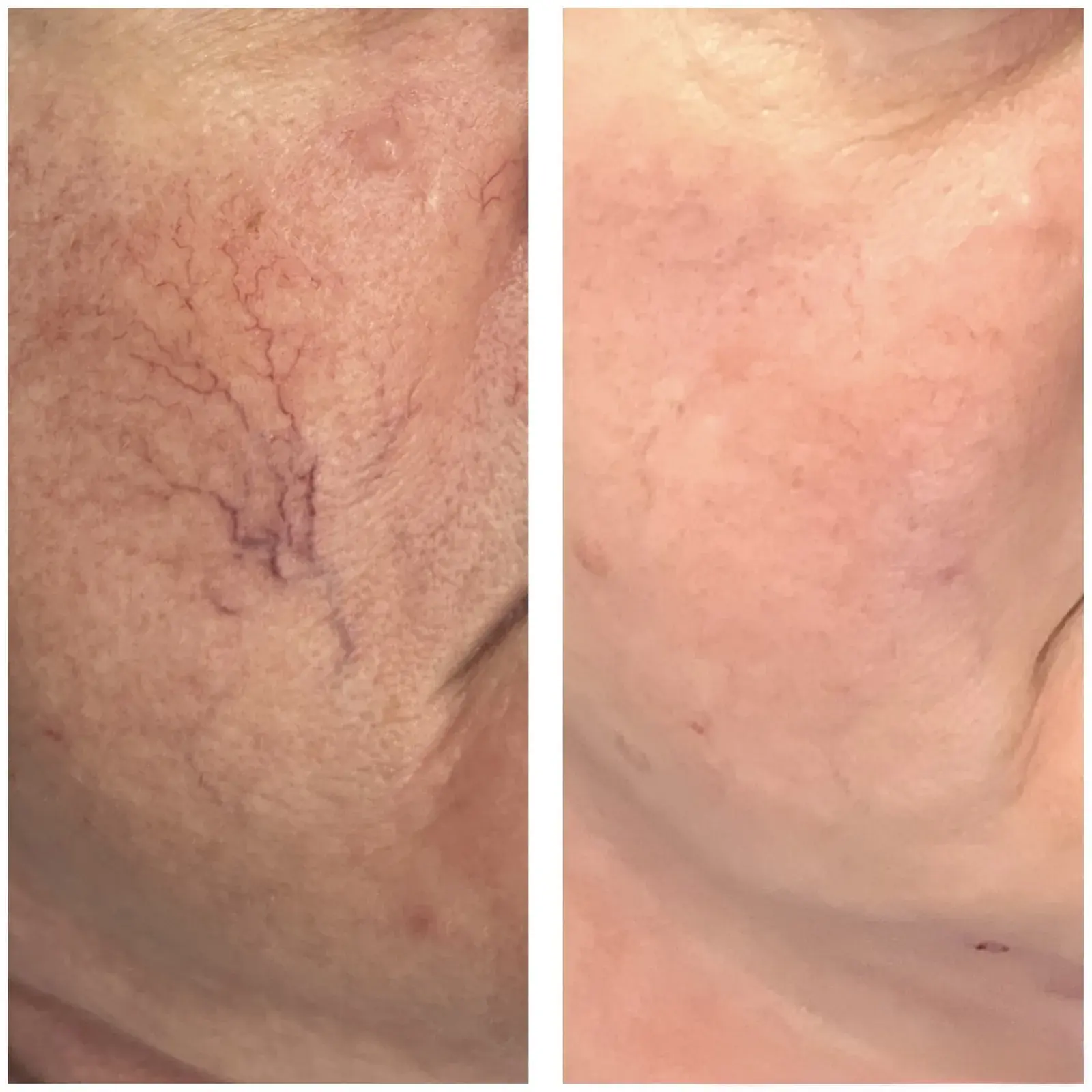 Before and after result, patient of Barrie Plastic Surgery