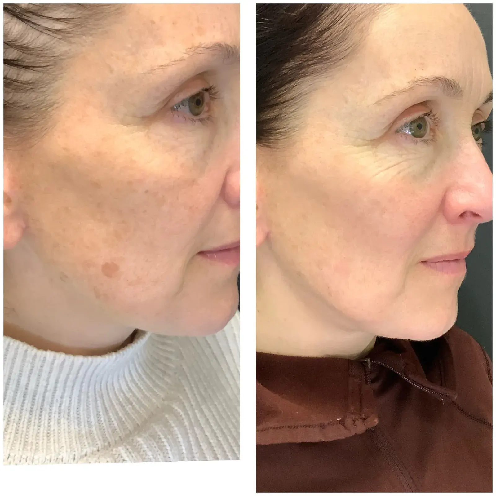 Before and after result, patient of Barrie Plastic Surgery