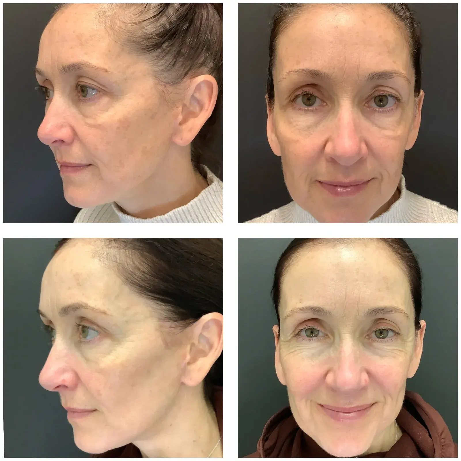 Before and after result, patient of Barrie Plastic Surgery