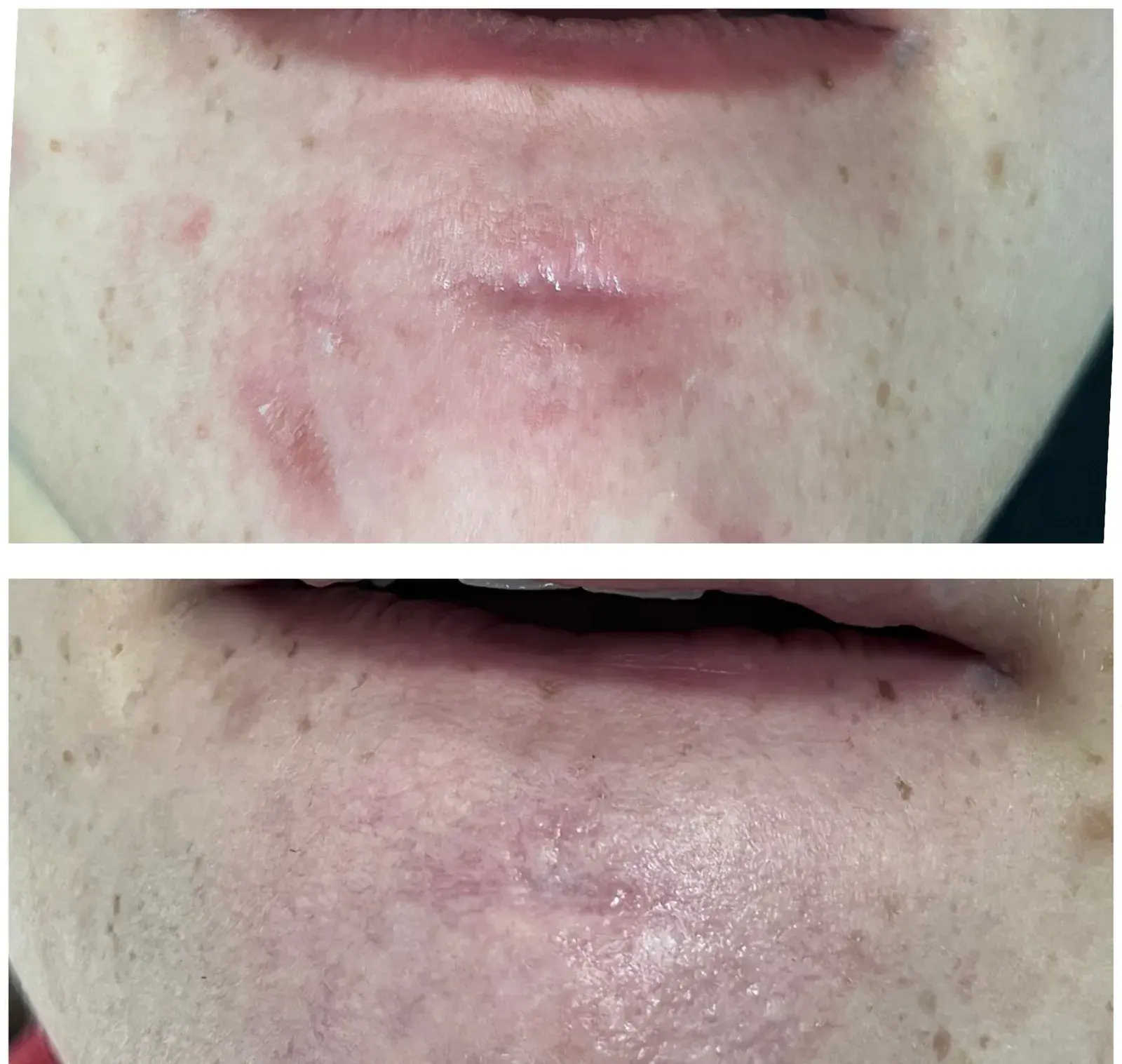 Before and after result, patient of Barrie Plastic Surgery