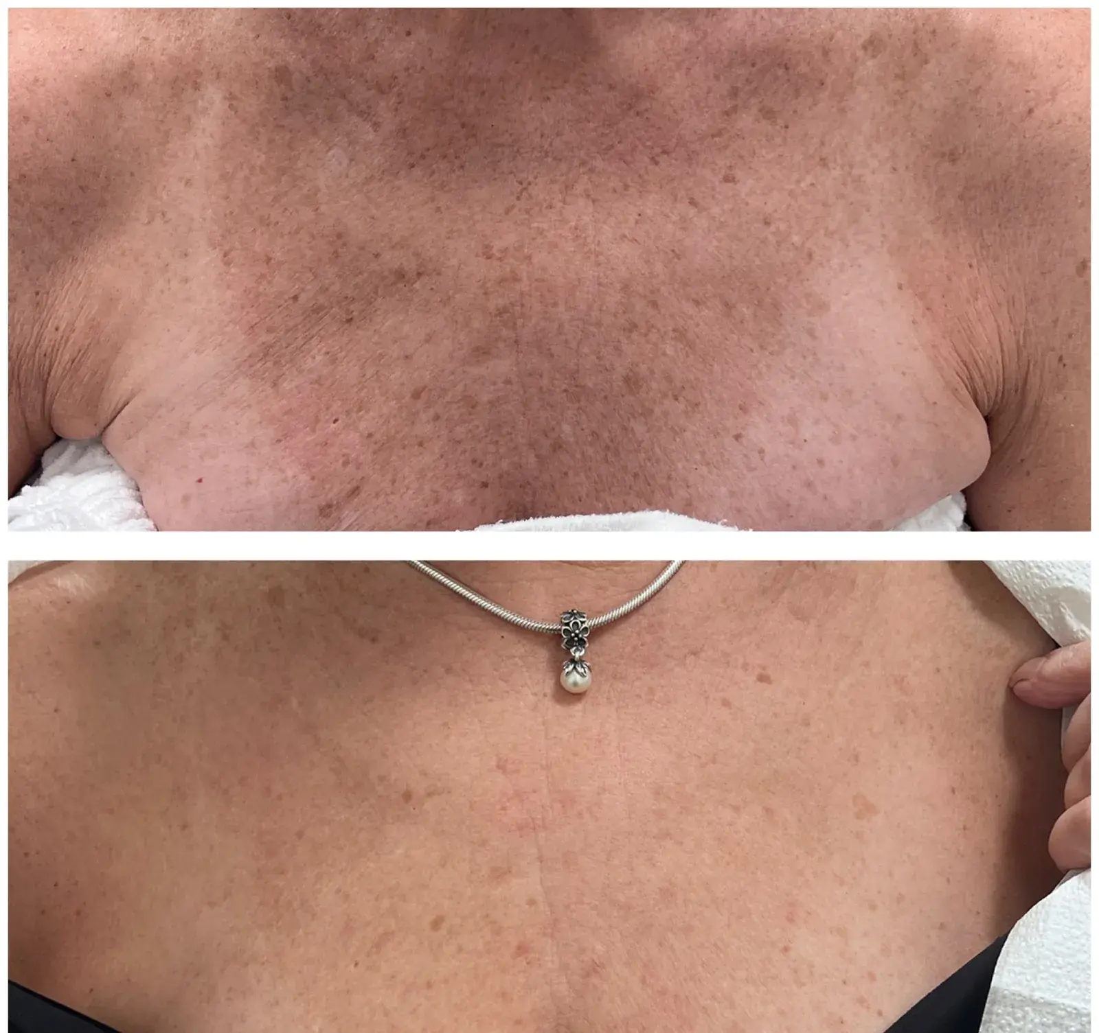 Before and after result, patient of Barrie Plastic Surgery