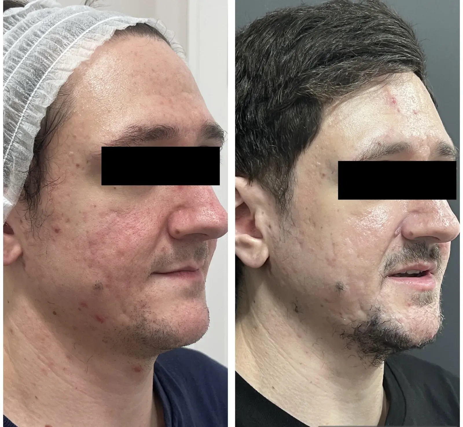 Before and after result, patient of Barrie Plastic Surgery