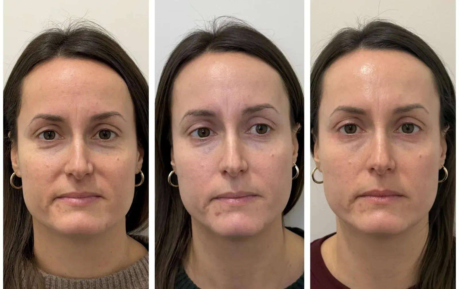 Before and after result, patient of Barrie Plastic Surgery