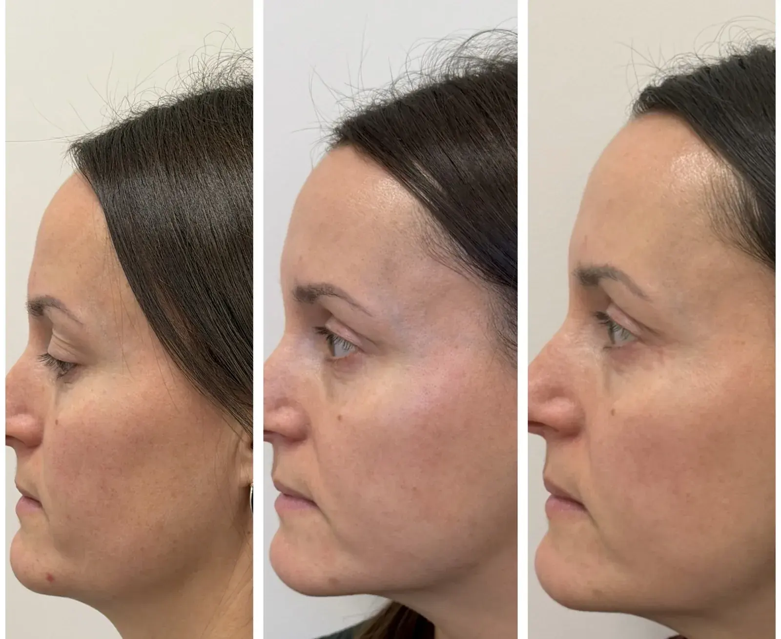 Before and after result, patient of Barrie Plastic Surgery