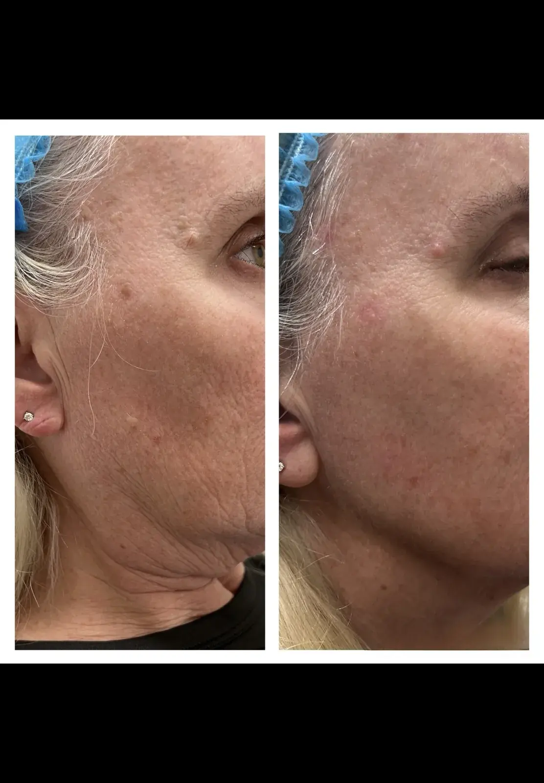 Before and after result, patient of Barrie Plastic Surgery