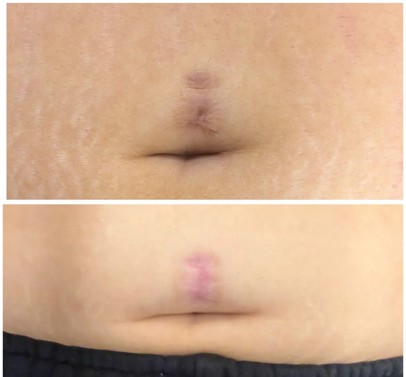 Before and after result, patient of Barrie Plastic Surgery