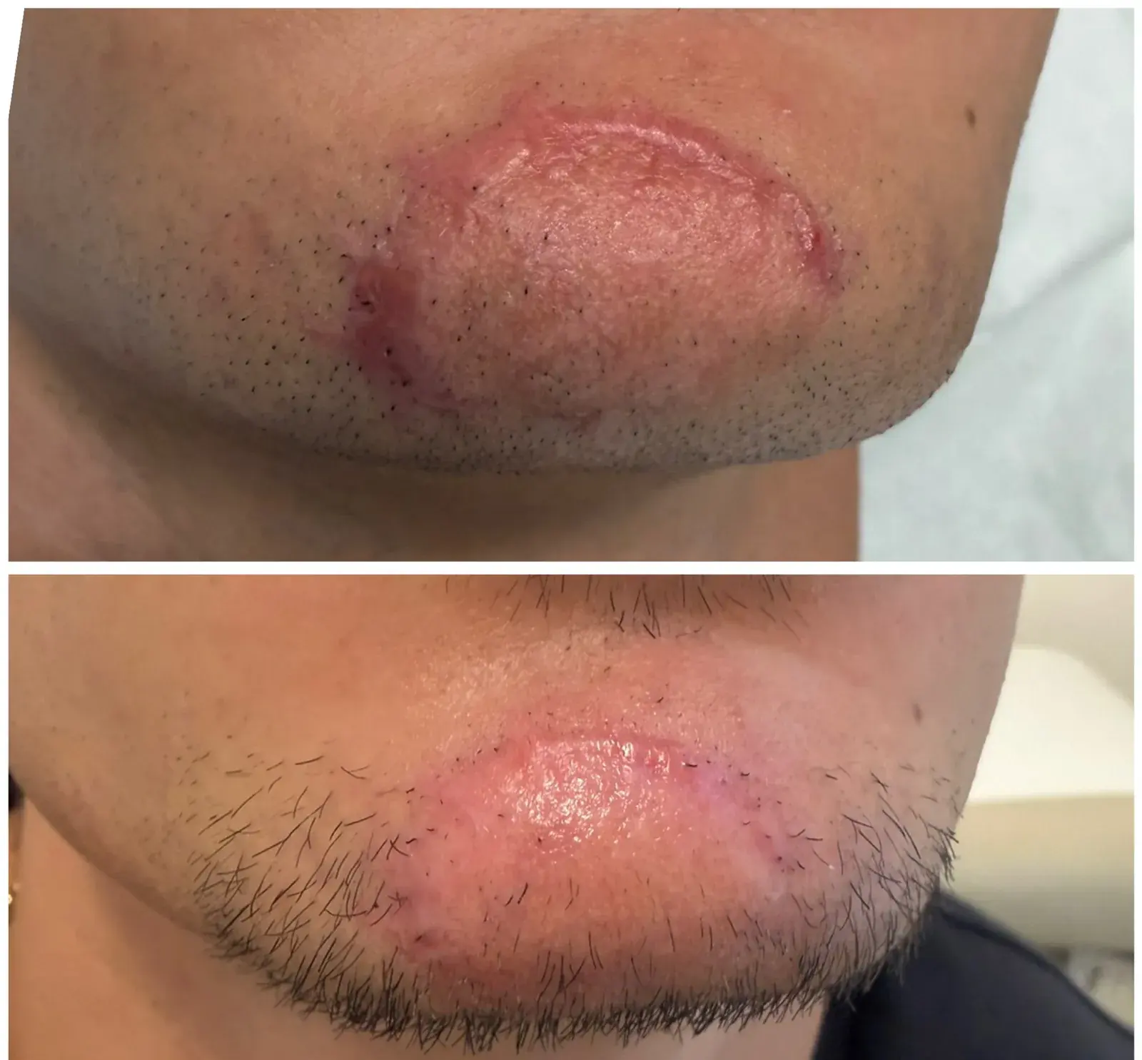 Before and after result, patient of Barrie Plastic Surgery