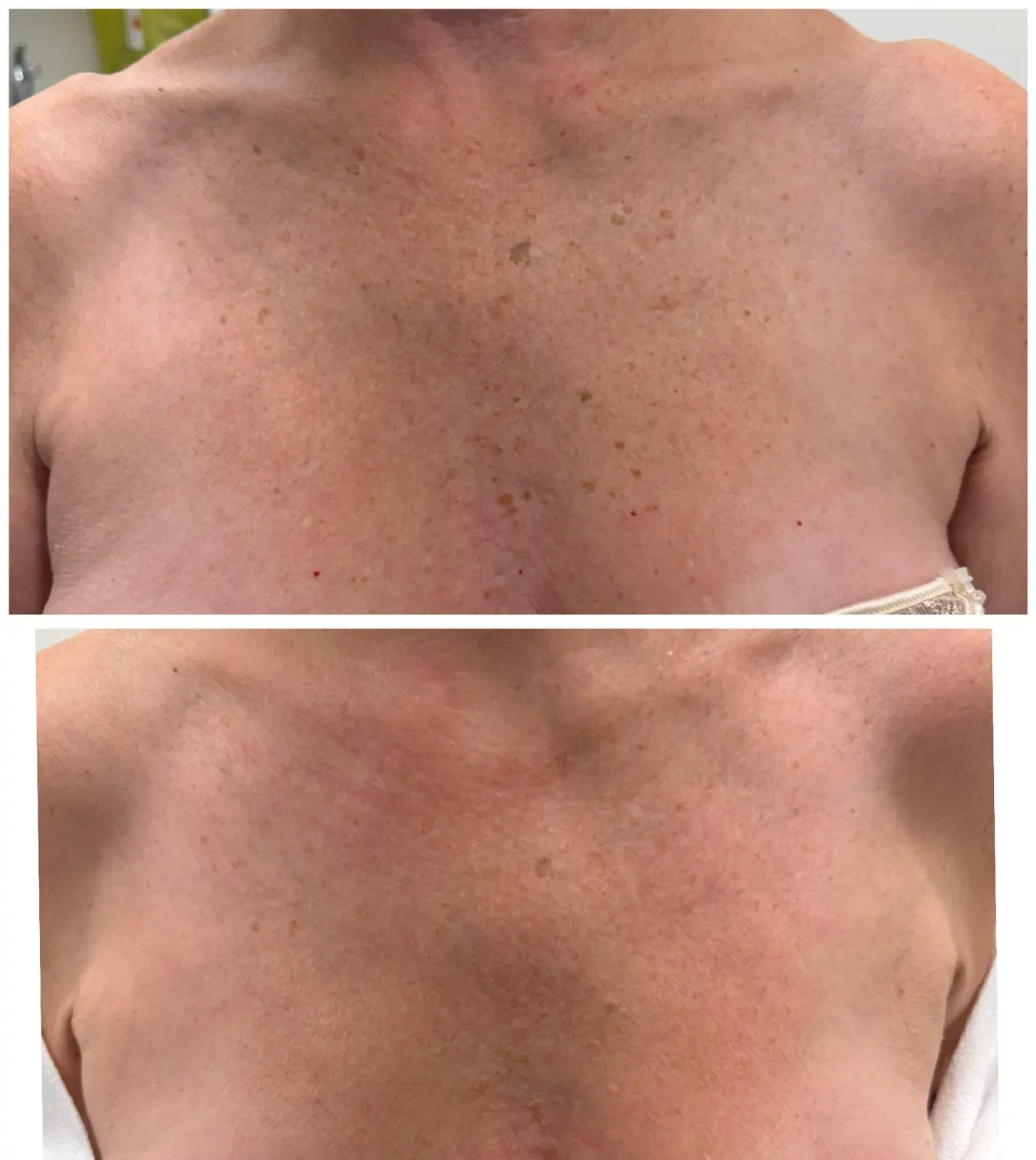 Before and after result, patient of Barrie Plastic Surgery