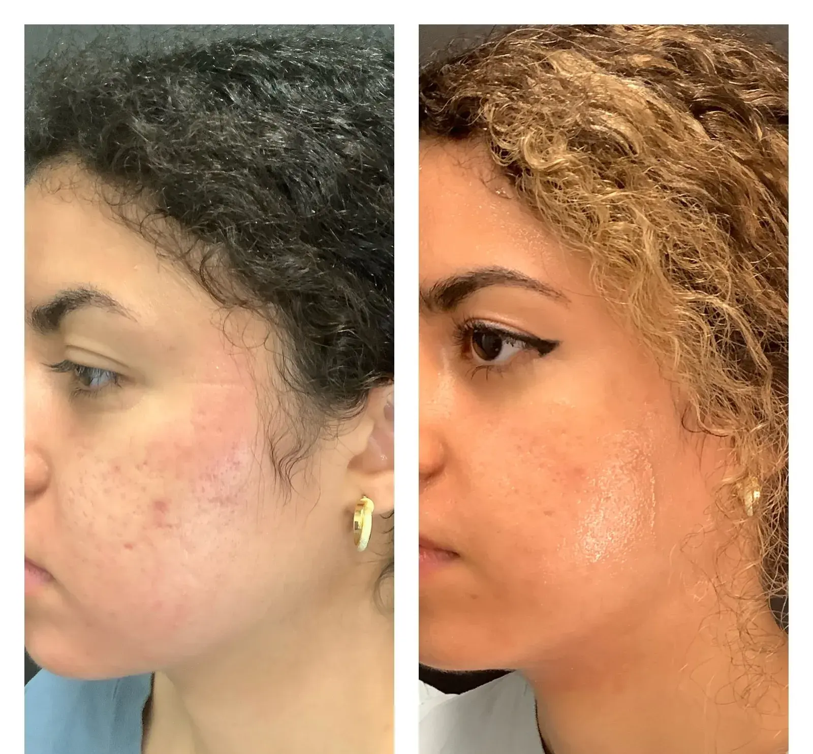 Face, oblique view, before and after at Barrie Plastic Surgery