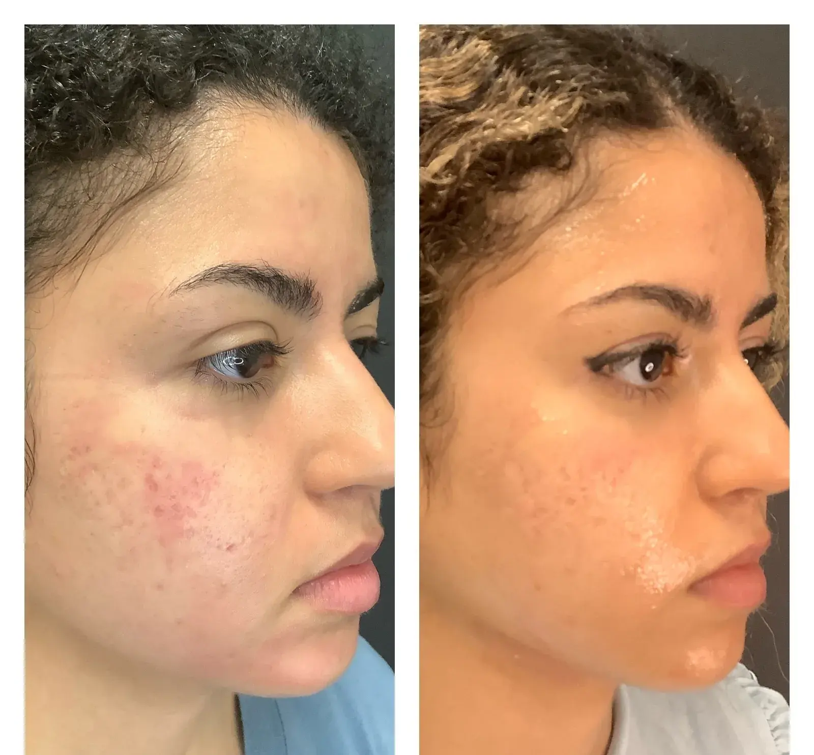 Face, oblique view, before and after at Barrie Plastic Surgery