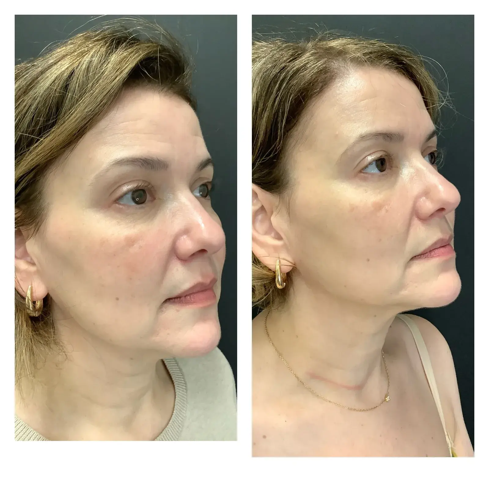 Face, oblique view, before and after at Barrie Plastic Surgery