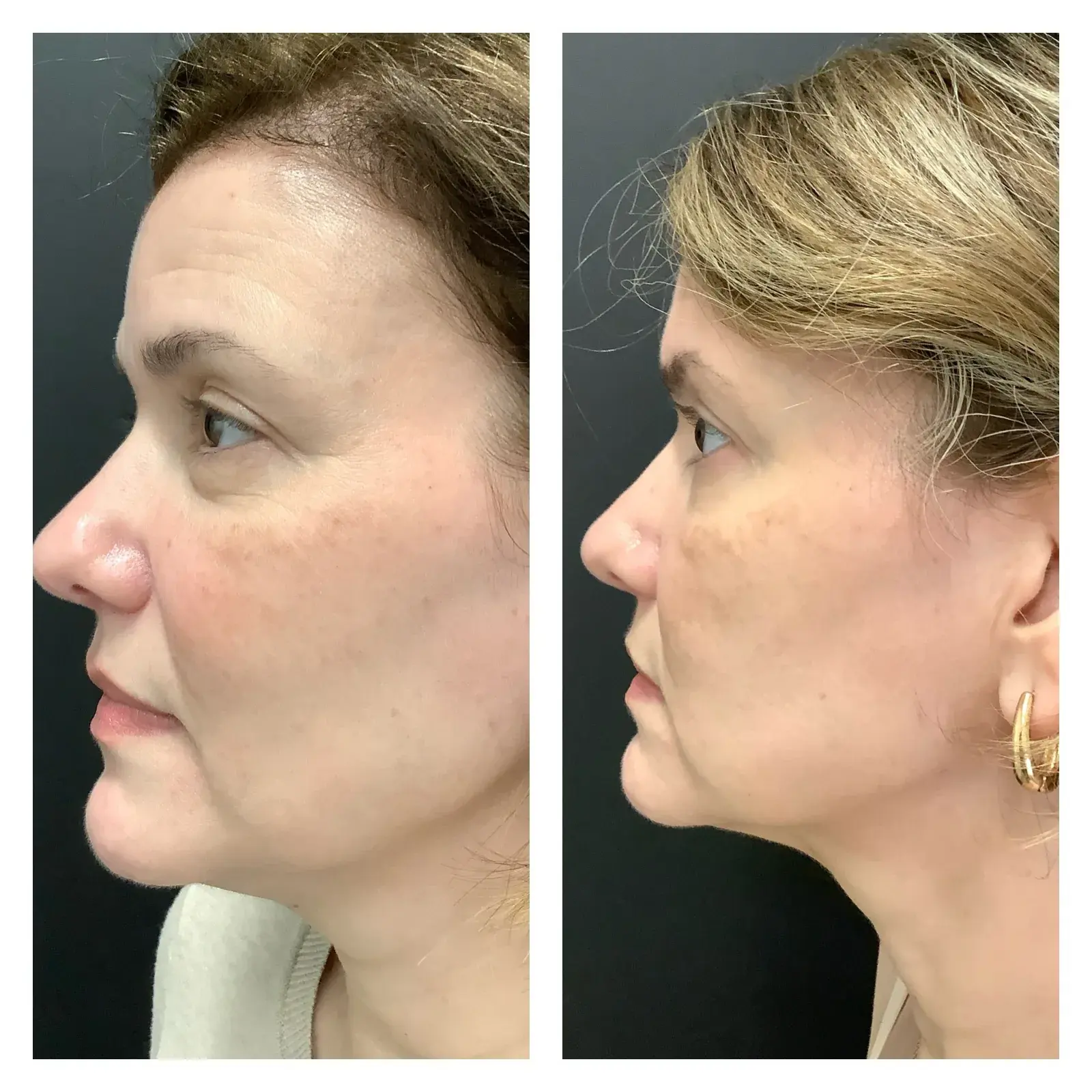Face, side view, before and after at Barrie Plastic Surgery