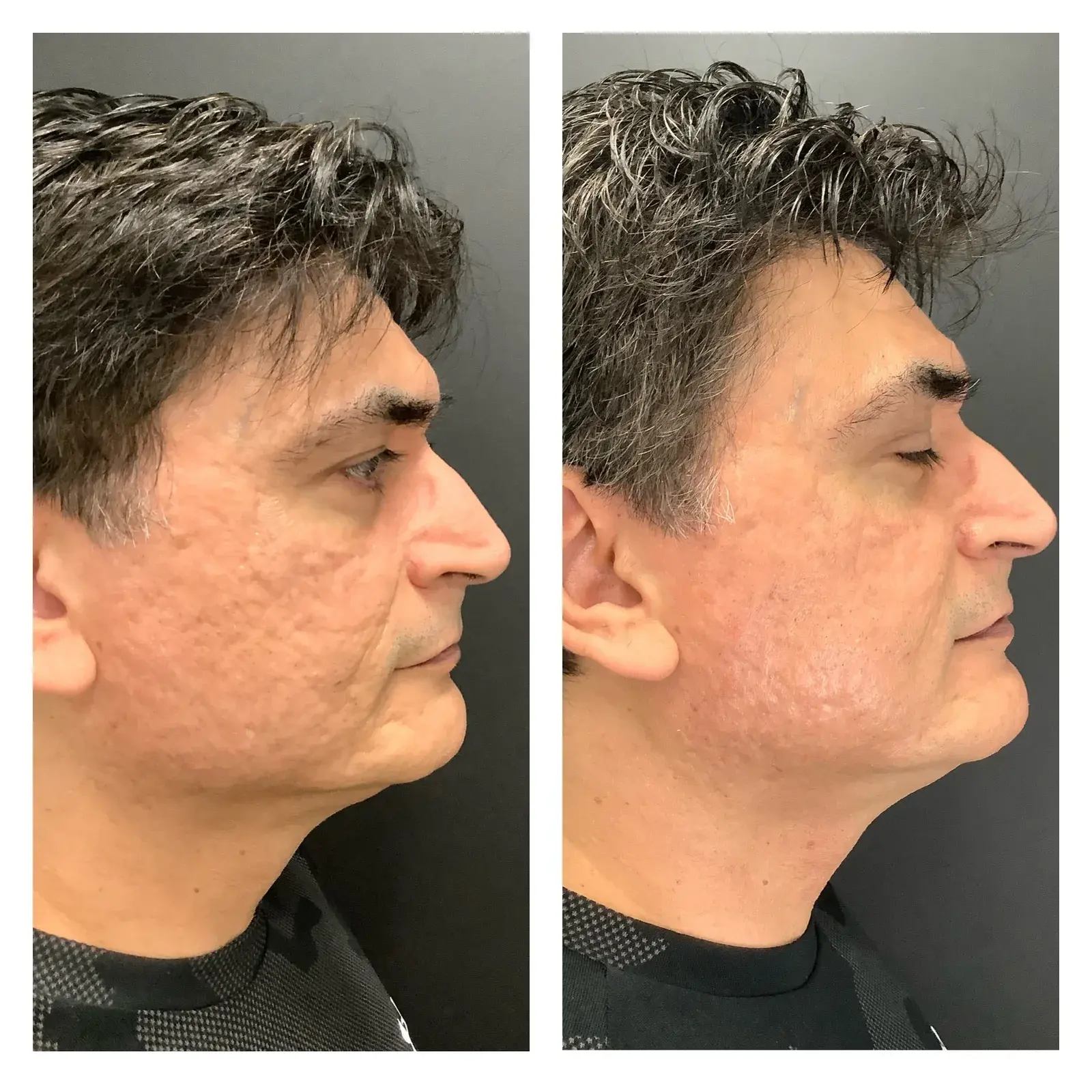 Face, side view, before and after at Barrie Plastic Surgery
