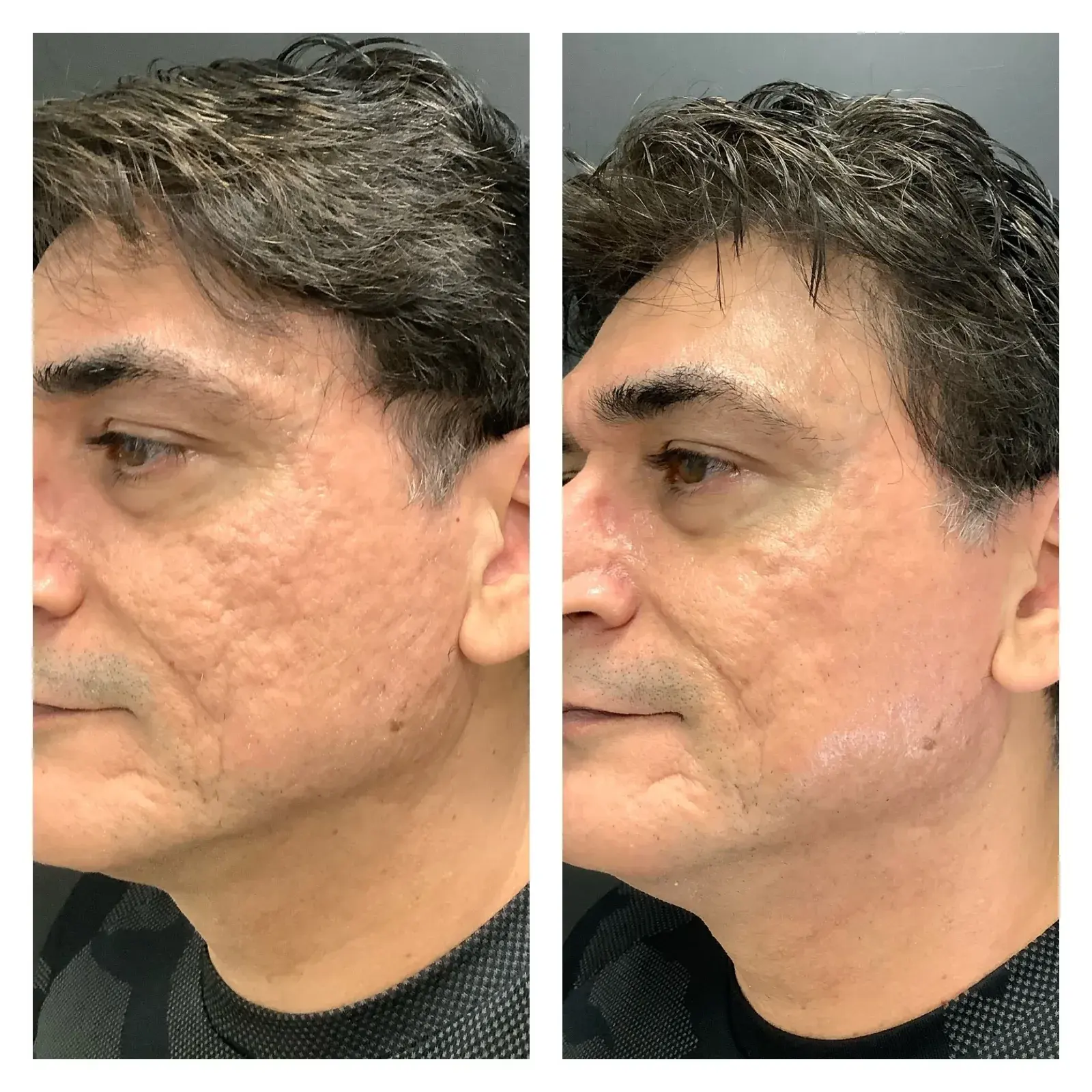 Face, oblique view, before and after at Barrie Plastic Surgery