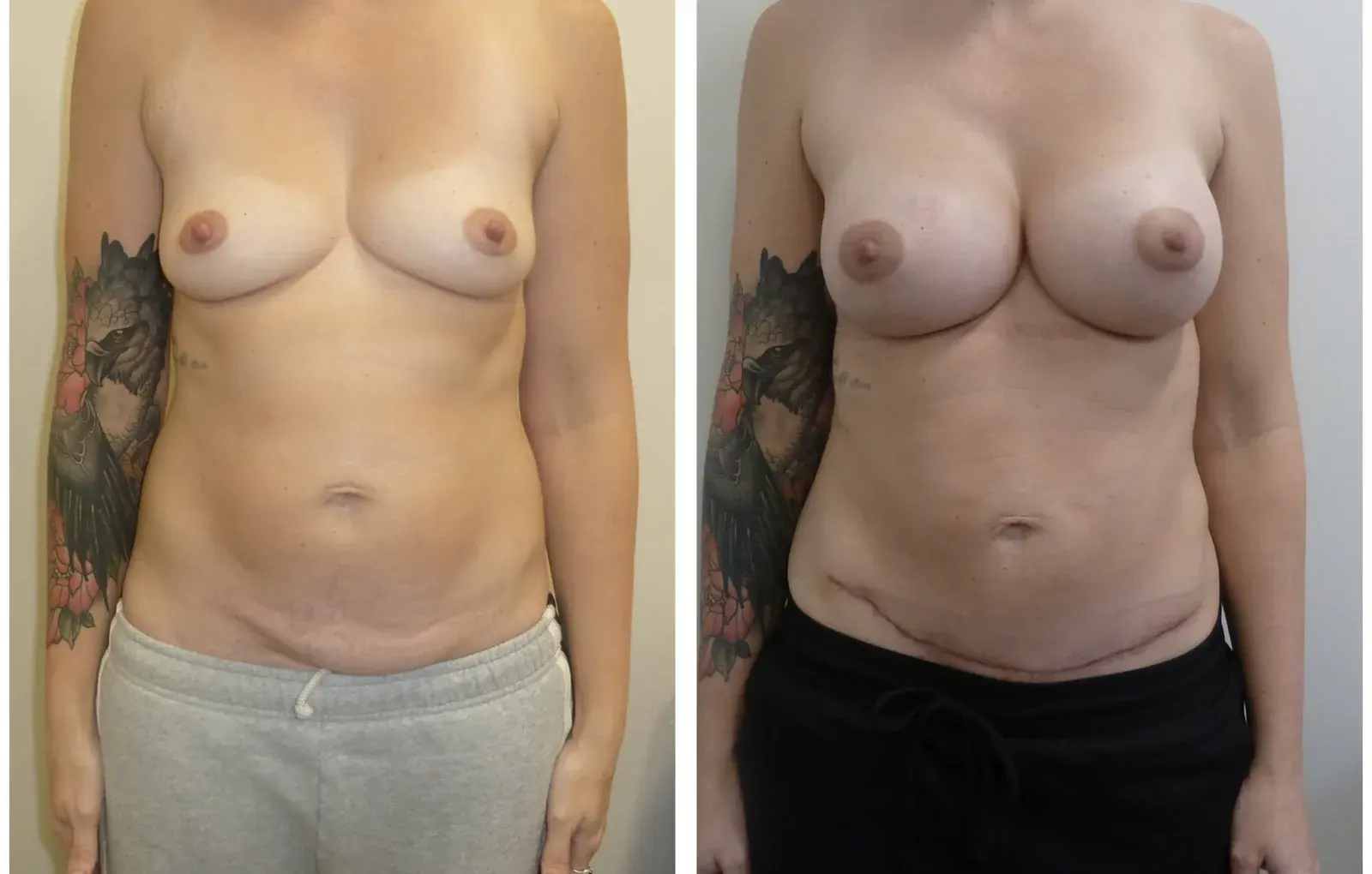 Breast and abdomen, front view, before and after at Barrie Plastic Surgery