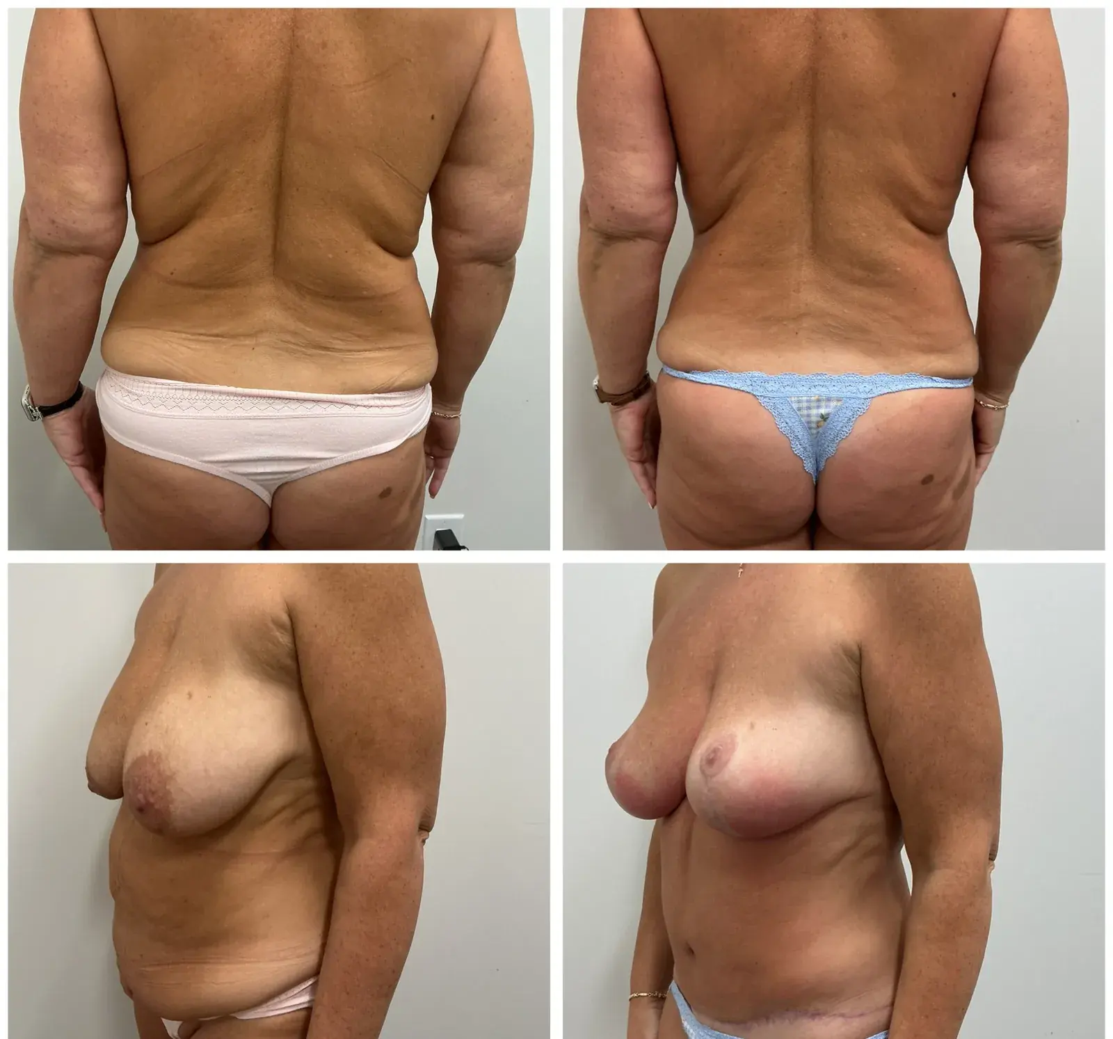 Breast and abdomen, back and side view, before and after at Barrie Plastic Surgery