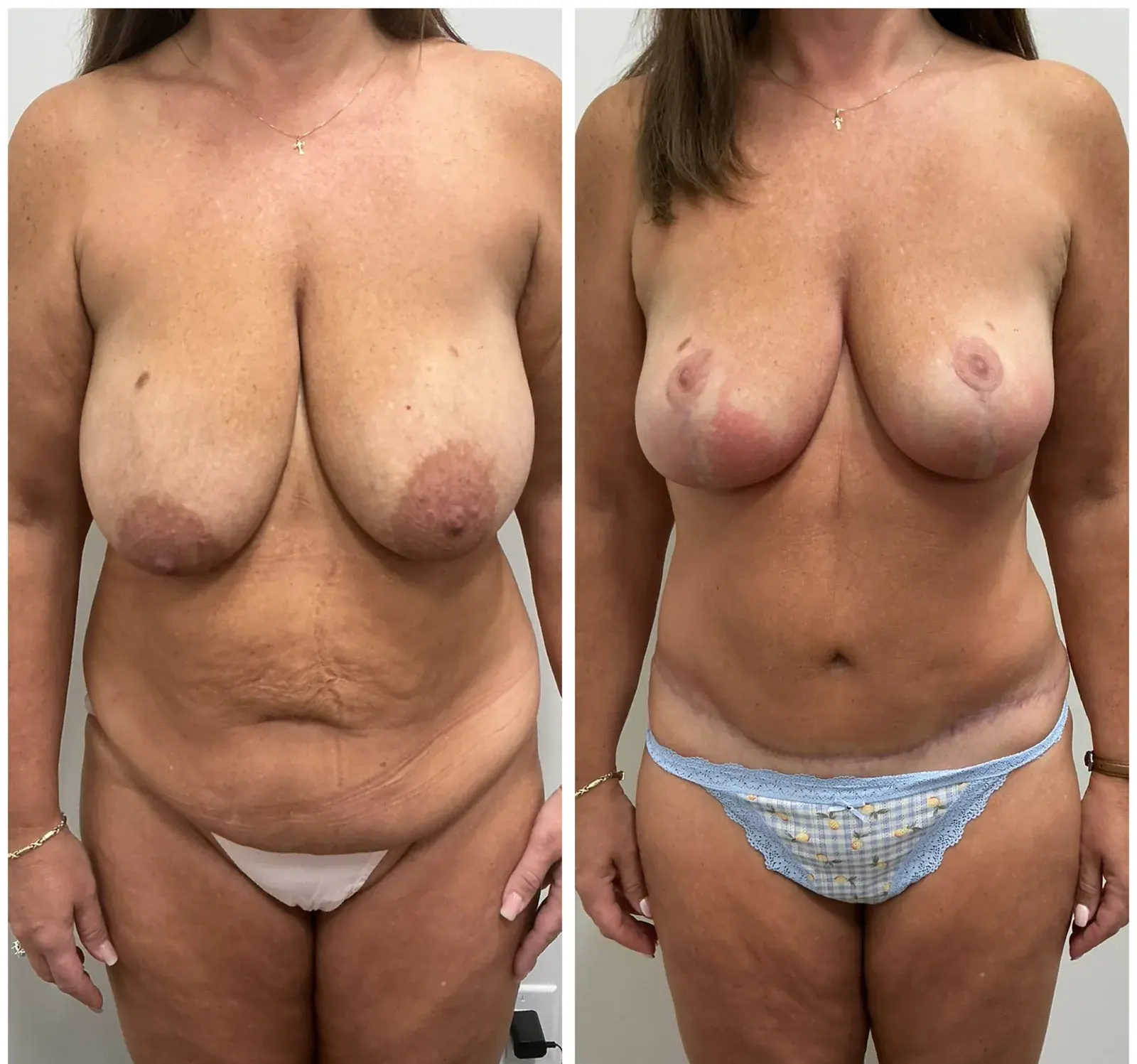 Breast and abdomen, front view, before and after at Barrie Plastic Surgery