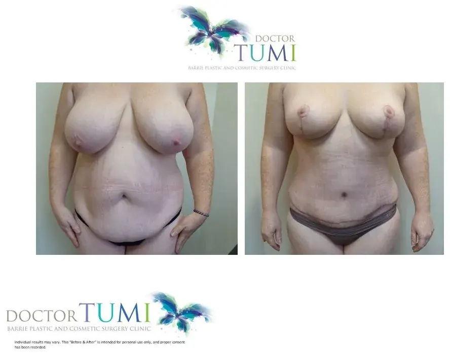 Breast and abdomen, front view, before and after at Barrie Plastic Surgery