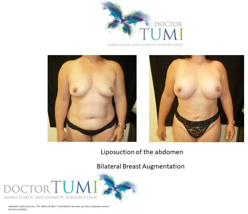 Breast and abdomen, front view, before and after at Barrie Plastic Surgery