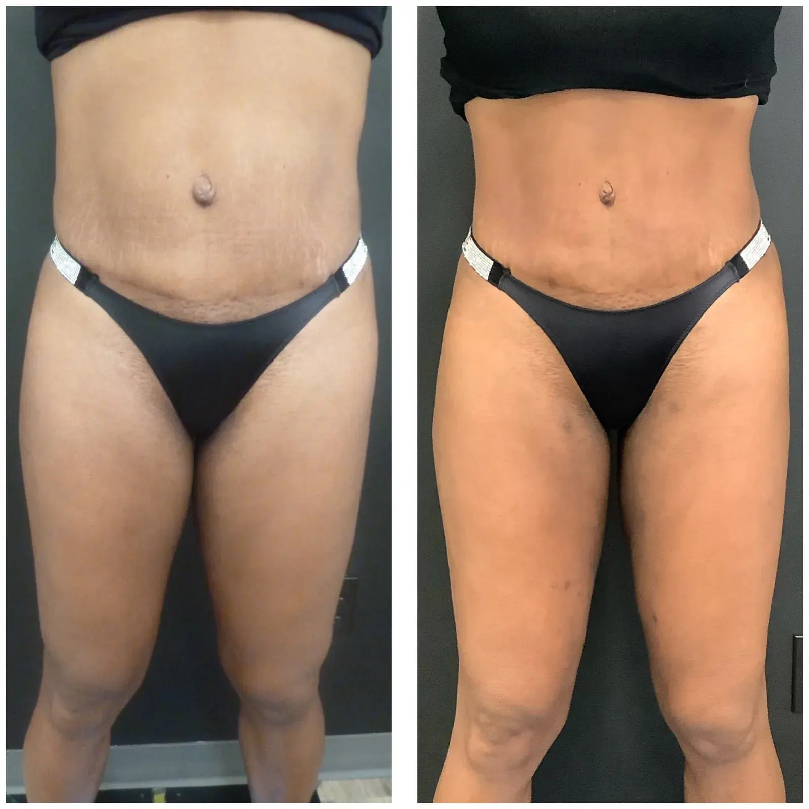 Abdomen and thighs, front view, before and after at Barrie Plastic Surgery