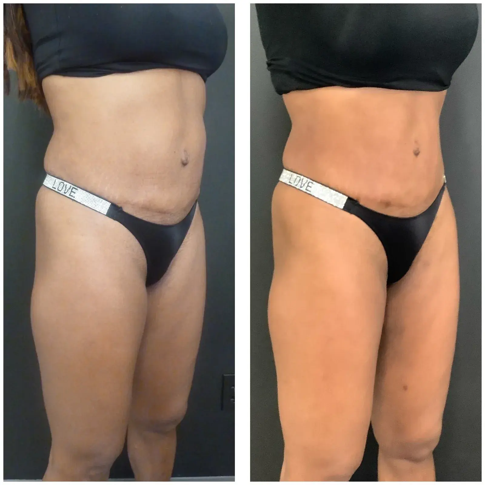 Abdomen and thighs, oblique view, before and after at Barrie Plastic Surgery
