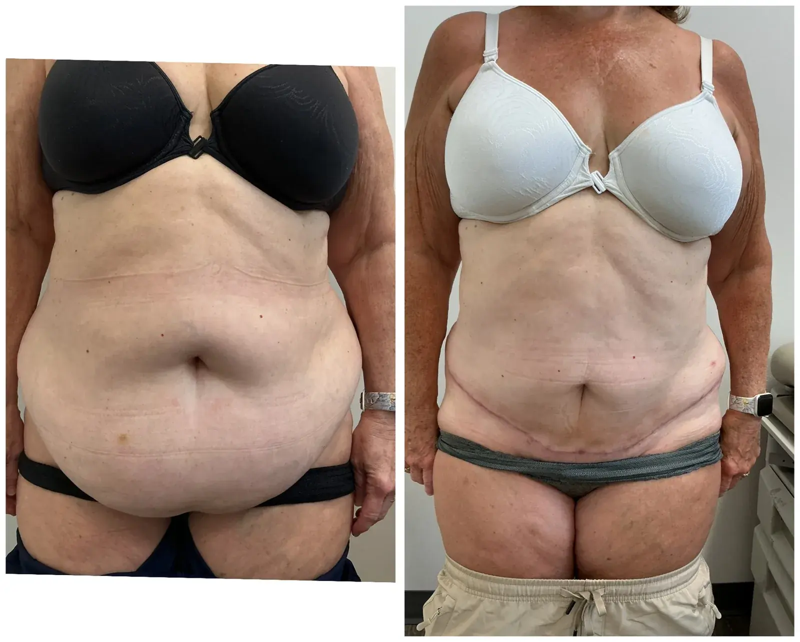 Abdomen, front view, before and after at Barrie Plastic Surgery