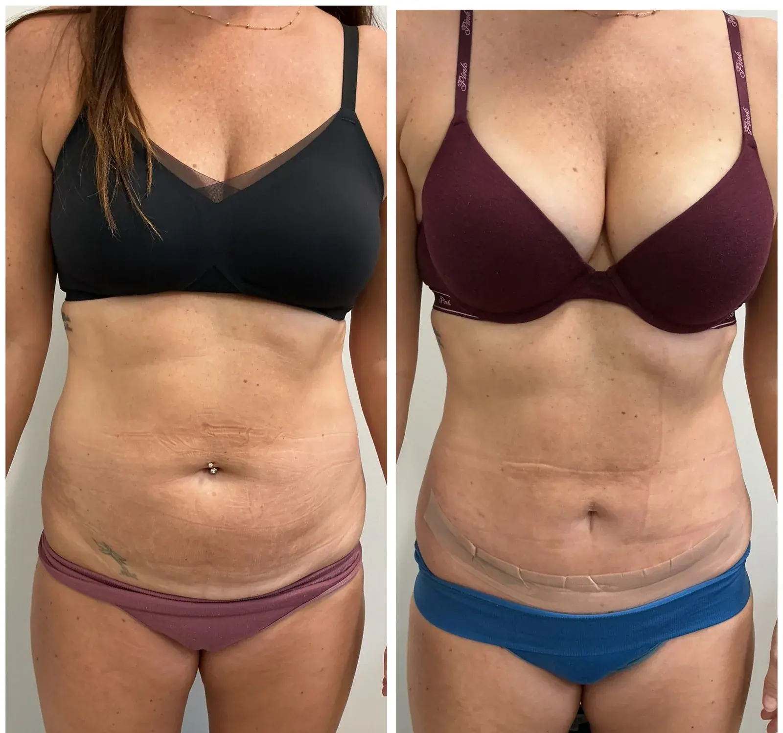 Abdomen, front view, before and after at Barrie Plastic Surgery